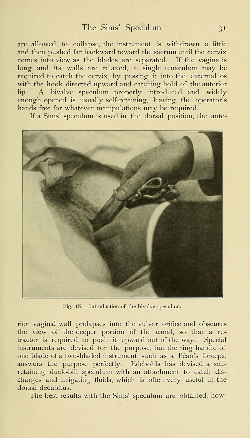 are allowed to collapse, the instrument is withdrawn a little and then pushed far backward toward the sacrum until the cervix comes into view as the blades are separated. If the vagina is long and its walls are relaxed, a single tenaculum may be required to catch the cervix, by passing it into the external os with the hook directed upward and catching hold of the anterior lip. A bivalve speculum properly introduced and widely enough opened is usually self-retaining, leaving the operator's hands free for whatever manipulations may be required. If a Sims' speculum is used in the dorsal position, the ante- Fig. 18.—Introduction of the bivalve speculum. rior vaginal wall prolapses into the vulvar orifice and obscures the view of the deeper portion of the canal, so that a re- tractor is required to push it upward out of the way. Special instruments are devised for the purpose, but the ring handle of one blade of a two-bladed instrument, such as a Pean's forceps, answers the purpose perfectly. Edebohls has devised a self- retaining duck-bill speculum with an attachment to catch dis- charges and irrigating fluids, which is often very useful in the dorsal decubitus. The best results with the Sims' speculum are obtained, how-