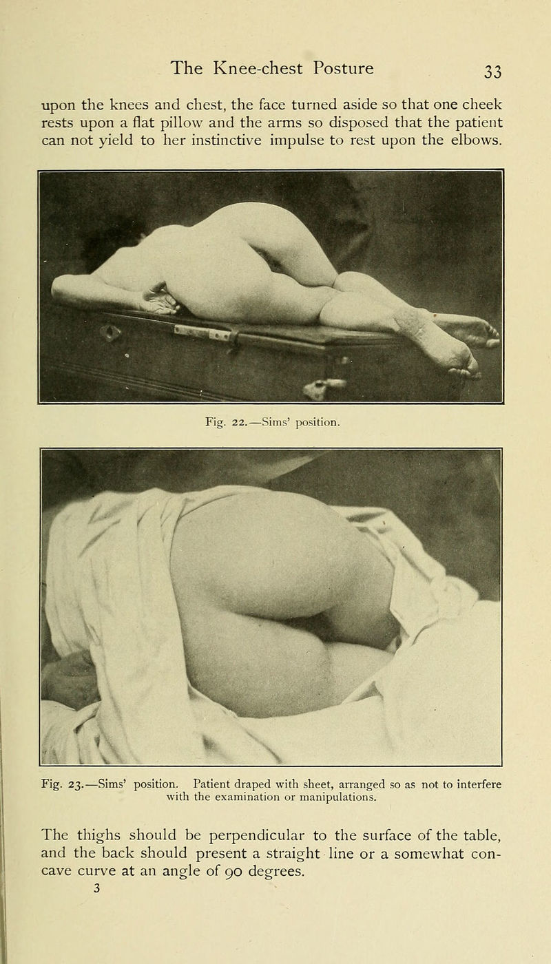 The Knee-chest Posture upon the knees and chest, the face turned aside so that one cheek rests upon a flat pillow and the arms so disposed that the patient can not yield to her instinctive impulse to rest upon the elbows. Fig. 22.—Sims' position. Fig. 23.—Sims' position. Patient draped with sheet, arranged so as not to interfere with the examination or manipulations. The thighs should be perpendicular to the surface of the table, and the back should present a straight line or a somewhat con- cave curve at an angle of 90 degrees. 3