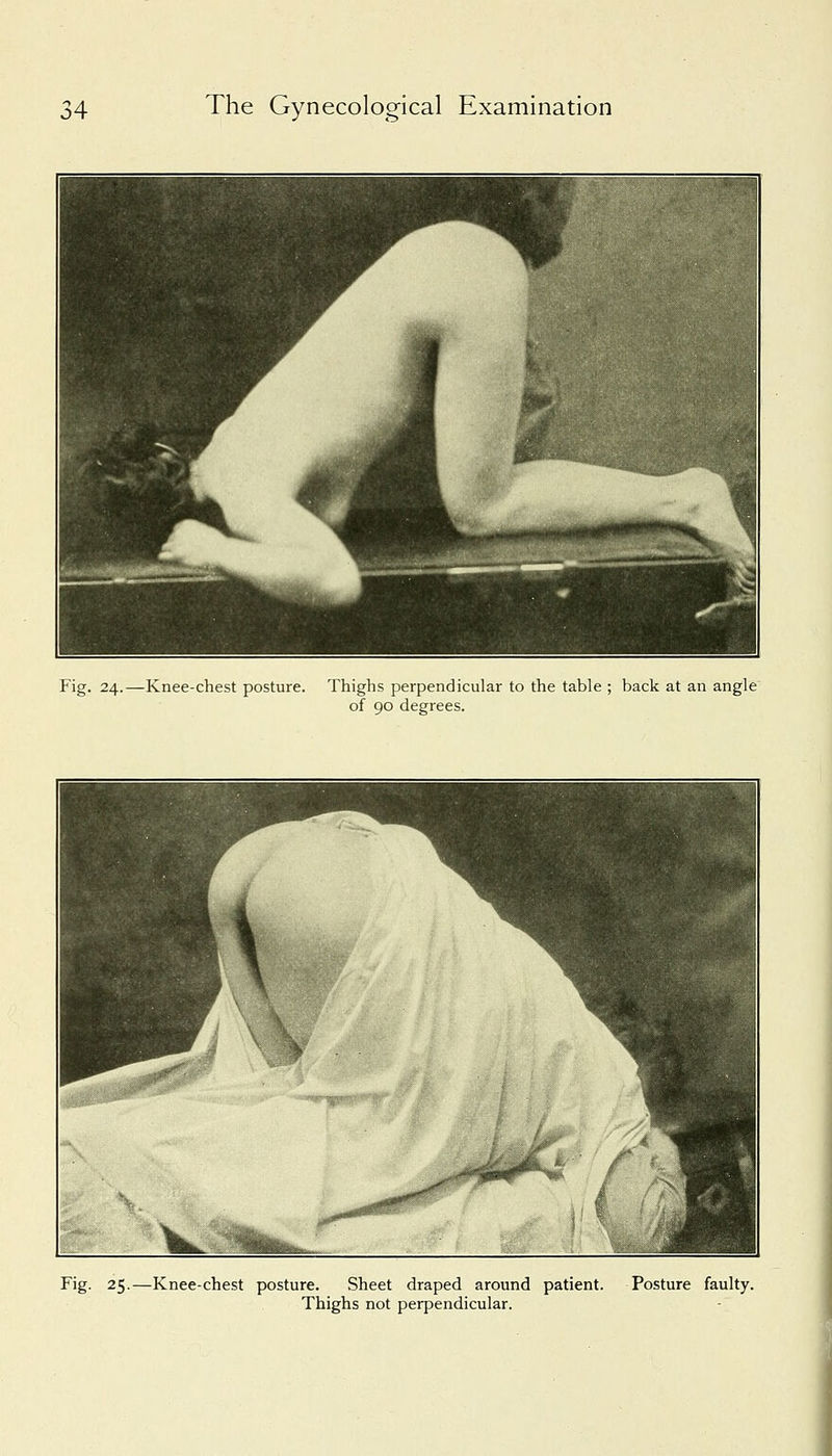 Fig. 24.—Knee-chest posture. Thighs perpendicular to the table ; back at an angle of 90 degrees. Fig. 25.—Knee-chest posture. Sheet draped around patient. Posture faulty. Thighs not perpendicular.