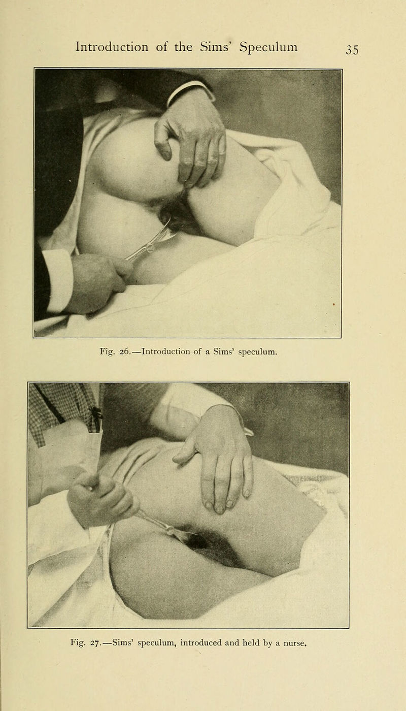 Fig. 26.—Introduction of a Sims' speculum. Fig. 27.—Sims' speculum, introduced and held by a nurse.