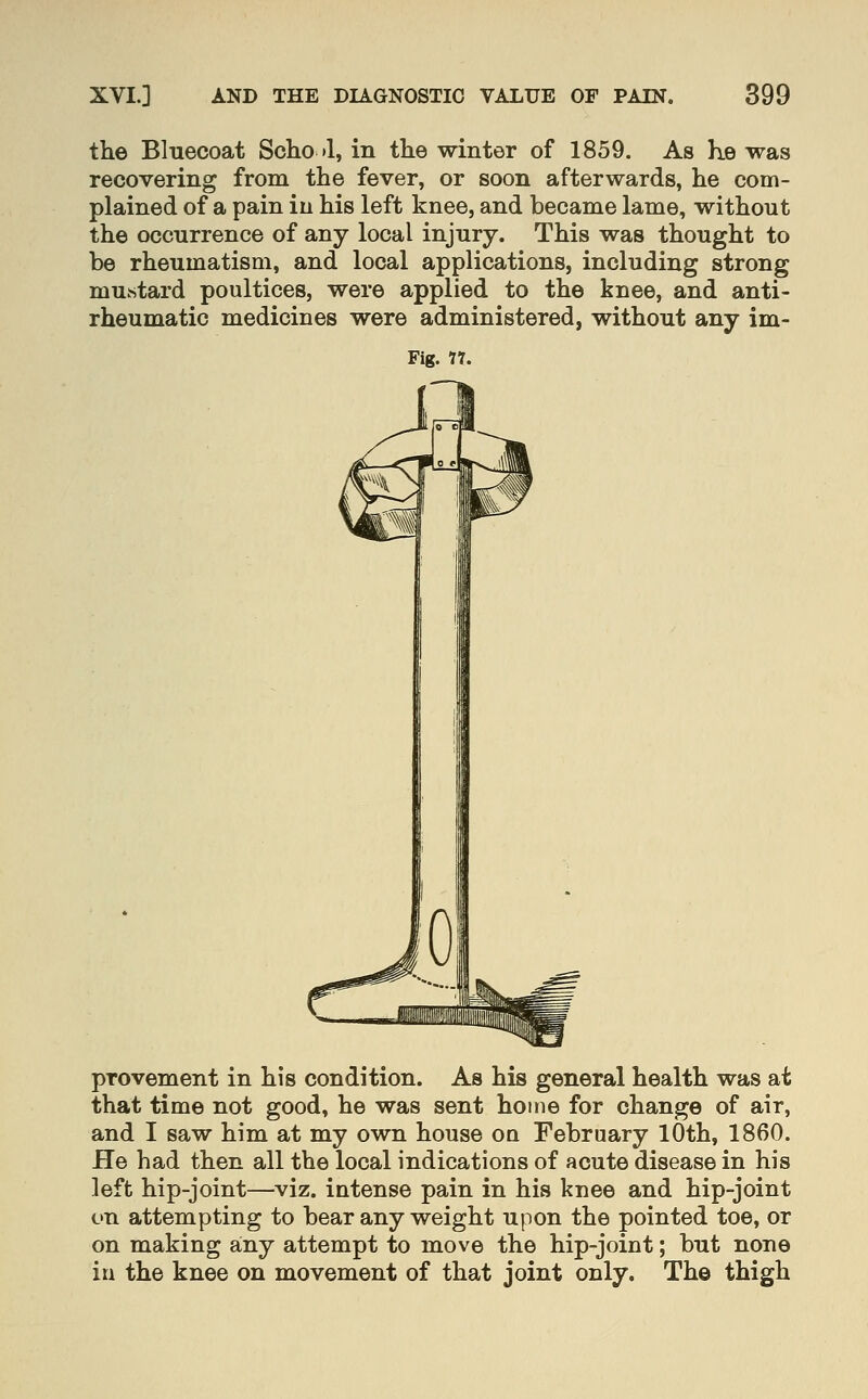 the Bluecoat Scho »1, in the winter of 1859. As he was recovering from the fever, or soon afterwards, he com- plained of a pain in his left knee, and became lame, without the occurrence of any local injury. This was thought to be rheumatism, and local applications, including strong mustard poultices, were applied to the knee, and anti- rheumatic medicines were administered, without any im- Fig. 77. provement in his condition. As his general health was at that time not good, he was sent home for change of air, and I saw him at my own house oa February lOth, 1860. He had then all the local indications of acute disease in his left hip-joint—viz. intense pain in his knee and hip-joint on attempting to bear any weight upon the pointed toe, or on making any attempt to move the hip-joint; but none in the knee on movement of that joint only. The thigh