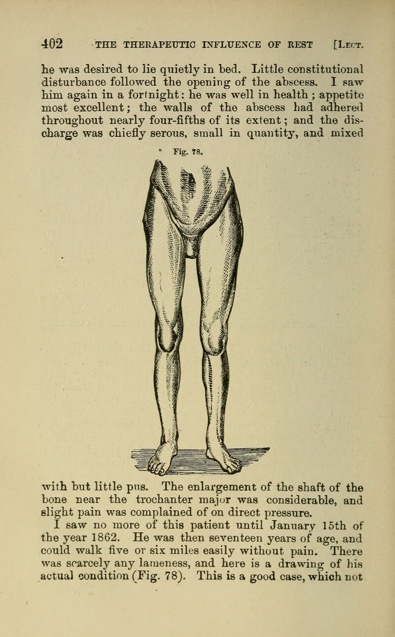 he was desired to lie quietly in bed. Little constitutional disturbance followed the opening of the abscess. I saw him again in a fortnight: he was well in health ; appetite most excellent; the walls of the abscess had adhered throughout nearly four-fifths of its extent; and the dis- charge was chiefly serous, small in quantity, and mixed ' Fig. rs. with but little pus. The enlargement of the shaft of the bone near the trochanter major was considerable, and slight pain was complained of on direct pressure. I saw no more of this patient until January 15th of the year 1862. He was then seventeen years of age, and could walk five or six miles easily without pain. There was scarcely any lameness, and here is a drawing of his actual condition (Fig. 78). This is a good case, which not