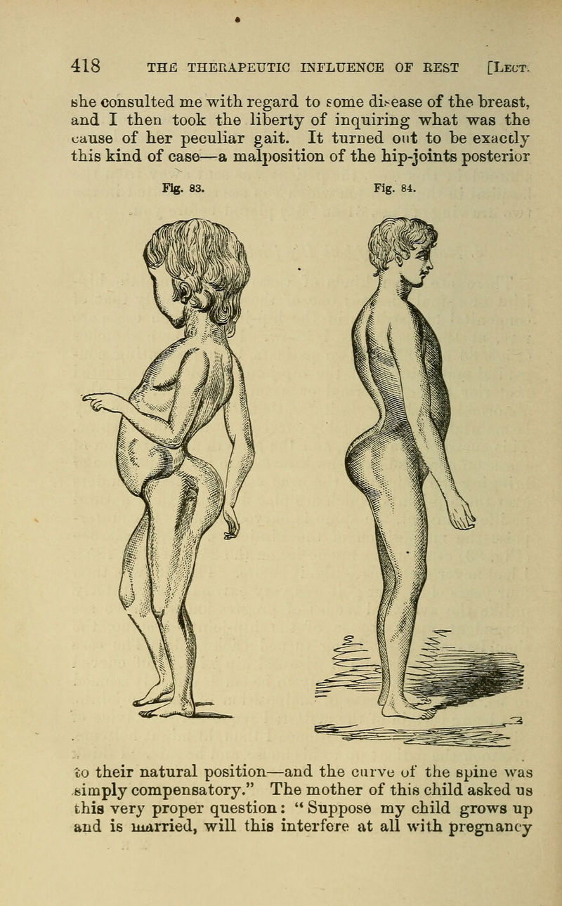 she consulted me with regard to some disease of the breast, and I then took the liberty of inquiring what was the cause of her peculiar gait. It turned out to be exactly this kind of case—a malposition of the hip-joints posterior Fig. 83. Fig. 84. to their natural position—and the curve uf the spine was -simply compensatory. The mother of this child asked us this very proper question;  Suppose my child grows up and is married, will this interfere at all with pregnancy