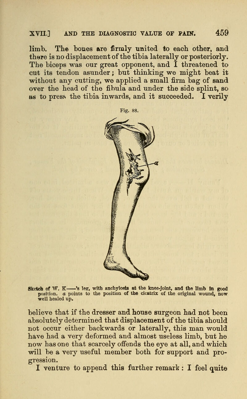 limb. The bones are firmly united to each other, and there is no displacement of the tibia laterally or posteriorly. The biceps was our great opponent, and I threatened to cut its tendon asunder; but thinking we might beat it without any cutting, we applied a small firm bag of sand over the head of the fibula and under the side splint, so as to press the tibia inwards, and it succeeded. I verily Sketch of W. K ^s Tes, with anchylosis at the knee-joint, and the limb to good position, a points to the position of the cicatrix of the original wound, now well healed up. believe that if the dresser and house surgeon had not been absolutely determined that displacement of the tibia should not occur either backwards or laterally, this man would have had a very deformed and almost useless limb, but he now has one that scarcely offends the eye at all, and which will be a very useful member both for support and pro- gression. I venture to append this further remark: I feel quite