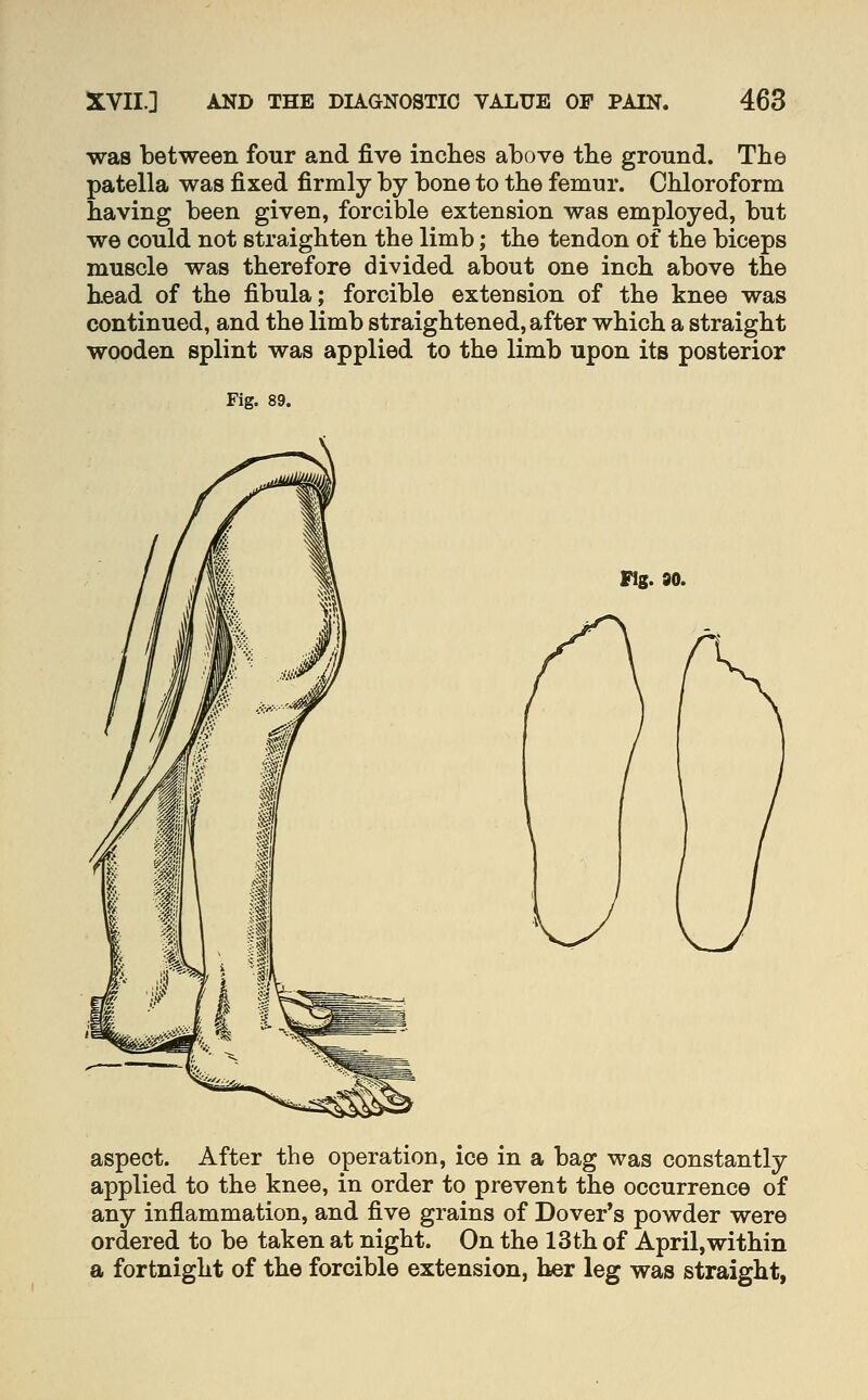 was between four and five inches above tbe ground. The patella was fixed firmly by bone to the femur. Chloroform having been given, forcible extension was employed, but we could not straighten the limb; the tendon of the biceps muscle was therefore divided about one inch above the head of the fibula; forcible extension of the knee was continued, and the limb straightened, after which a straight wooden splint was applied to the limb upon its posterior Fig. 89. Fig. 80. aspect. After the operation, ice in a bag was constantly applied to the knee, in order to prevent the occurrence of any inflammation, and five grains of Dover's powder were ordered to be taken at night. On the 13th of April,within a fortnight of the forcible extension, her leg was straight,