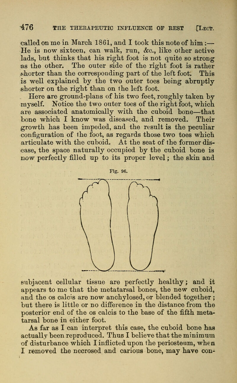 called on me in March 1861, and I took this note of Him:— He is now sixteen, can walk, run, &c., like other active lads, but thinks that his right foot is not quite so strong as the other. The outer side of the right foot is rather shorter than the corresponding part of the left foot. This is well explained by the two outer toes being abruptly shorter on the right than on the left foot. Hei'e are ground-plans of his two feet, roughly taken by myself, Notice the two outer toes of the right foot, which are associated anatomically with the cuboid bone—that bone which I know was diseased, and removed. Their growth has been impeded, and the result is the peculiar configuration of the foot, as regards those two toes which articulate with the cuboid. At the seat of the former dis- ease, the space naturally occupied by the cuboid bone is now perfectly filled up to its proper level; the skin and Fig. 96- eubjacent cellular tissue are perfectly healthy; and it appears to me that the metatarsal bones, the new cuboid, and the os calcis are now anchylosed, or blended together ; but there is little or no difference in the distance from the posterior end of the os calcis to the base of the fifth meta- tarsal bone in either foot. As far as I can interpret this case, the cuboid bone has actually been reproduced. Thus I believe that the minimum of disturbance which I inflicted upon the periosteum, when I removed the necrosed and carious bone, may have con-