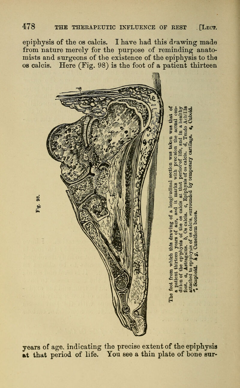 epiphysis of the os calcis. I have had this drawing made from nature merely for the purpose of reminding anato- mists and surgeons of the existence of the epiphysis to tha OS calcis. Here (Fig. 98) is the foot of a patient thirteen years of age. indicating the precise extent of the epiphysis ftt that period of life. You see a thin plate of bone sur-