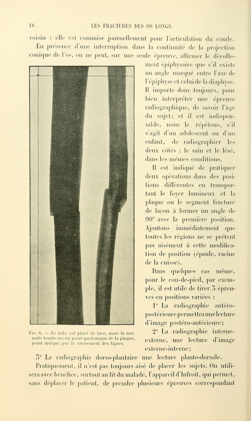 voisin : elle est commise journellement pour Tarticulation du coude. En présence dune interruption dans la continuité de la projection conique de l'os, on ne peut, sur une seule épreuve, affirmer le décolle- ment épiphysaire que s'il existe un angle marqué entre Taxe de l'épiphyse et celui de la diaphyse. 11 importe donc toujours, pour bien interpréter une épreuve radiographique, de savoir l'âge du sujet; et il est indispen- sable, nous le répétons, sil s'agit d'un adolescent ou d'un enfant, de radiographier les deux côtés : le sain et le lésé, dans les mêmes conditions. il est indiqué de pratiquer deux opérations dans des posi- tions différentes en transpor- tant le foyer lumineux et la plaque ou le segment fracturé de façon à former un angle de 90° avec la première position. Ajoutons immédiatement que toutes les régions ne se prêtent pas aisément à cette modifica- tion de position (épaule, racine de la cuisse). Dans quelques cas même, pour le cou-de-pied, par exem- ple, il est utile de tirer 5 épreu- ves en positions variées : 1 La radiographie antéro- postérieure permettra une lecture d'image postéro-antérieure ; 2 La radiographie interne- externe, une lecture d'image externe-interne ; 5° La radiographie dorso-plantaire une lecture planto-dorsale. Pratiquement, il n'est pas toujours aisé de placer les sujets. On utili- seraavec bénéfice, surtout au lit du malade, l'appareil d'Infroit, qui permet, sans déplacer le patient, de prendre plusieurs épreuves correspondant FiG. G. — Le tube est placé de face, mais la nor- male tombe sur un point quelconque de la plaque, point indiqué par le croisement des lignes.