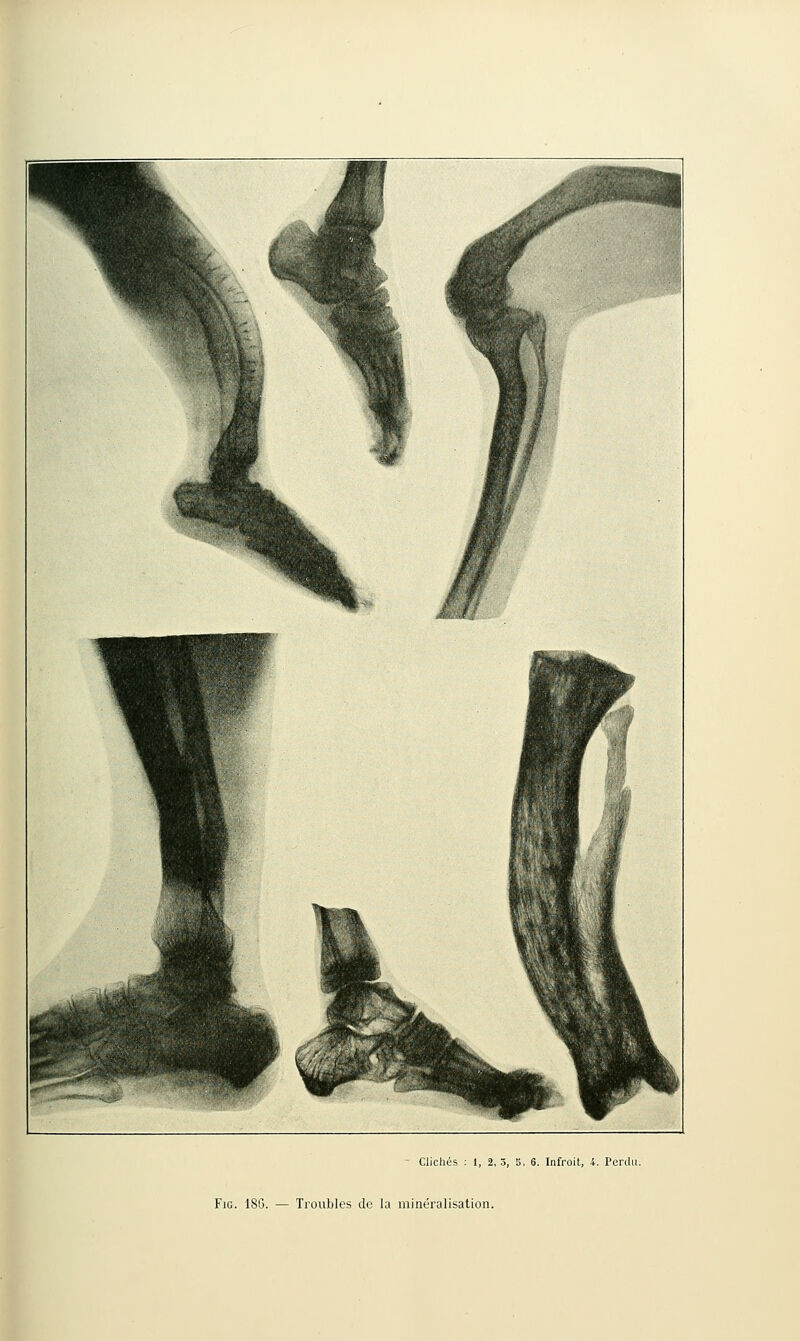 FiG. 186. — Troubles de la minéralisation.