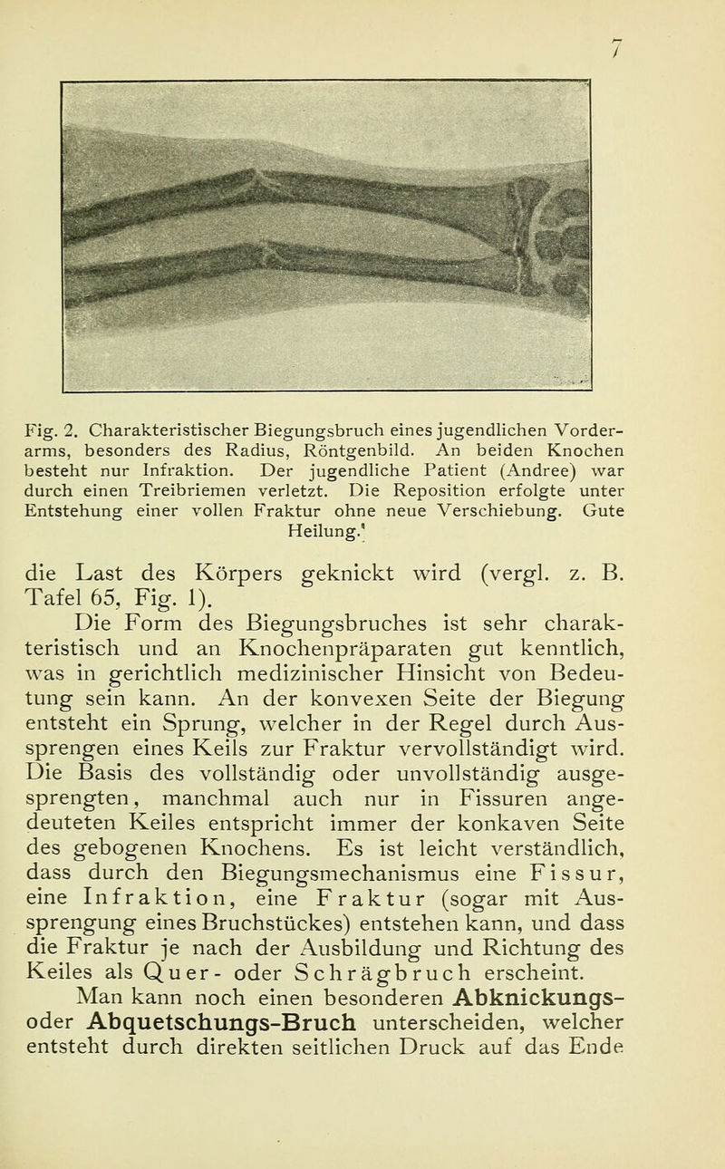Fig. 2. Charakteristischer Biegungsbruch eines jugendlichen Vorder- arms, besonders des Radius, Röntgenbild. An beiden Knochen besteht nur Infraktion. Der jugendliche Patient (Andree) war durch einen Treibriemen verletzt. Die Reposition erfolgte unter Entstehung einer vollen Fraktur ohne neue Verschiebung. Gute Heilung.' die Last des Körpers geknickt wird (vergl. z. B. Tafel 65, Fig. 1). Die Form des Biegungsbruches ist sehr charak- teristisch und an Knochenpräparaten gut kenntlich, was in gerichtlich medizinischer Hinsicht von Bedeu- tung sein kann. An der konvexen Seite der Biegung entsteht ein Sprung, welcher in der Regel durch Aus- sprengen eines Keils zur Fraktur vervollständigt wird. Die Basis des vollständig oder unvollständig ausge- sprengten , manchmal auch nur in Fissuren ange- deuteten Keiles entspricht immer der konkaven Seite des gebogenen Knochens. Es ist leicht verständlich, dass durch den Biegungsmechanismus eine Fissur, eine Infraktion, eine Fraktur (sogar mit Aus- sprengung eines Bruchstückes) entstehen kann, und dass die Fraktur je nach der Ausbildung und Richtung des Keiles als Quer- oder Schrägbruch erscheint. Man kann noch einen besonderen Abknickungs- oder Abquetschungs-Bruch unterscheiden, welcher entsteht durch direkten seitlichen Druck auf das Ende