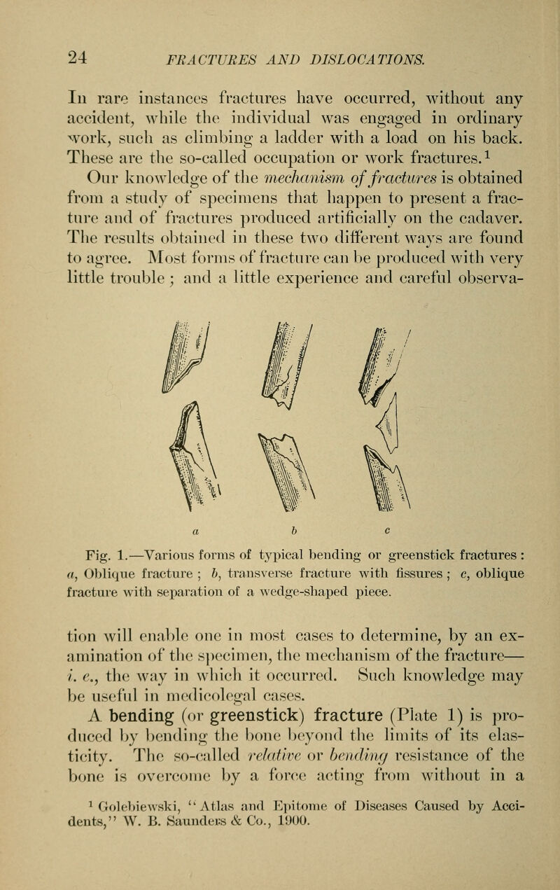 Ill rare instances fractures have occurred, without any accident, while the individual was engaged in ordinary work, such as climbing a ladder with a load on his back. These are the so-called occupation or work fractures. ^ Our knowledge of the mechanism of fractures is obtained from a study of specimens that happen to present a frac- ture and of fractures produced artificially on the cadaver. The results obtained in these two different ways are found to agree. Most forms of fracture can be produced with very little trouble; and a little experience and careful observa- Fig. 1.—Various forms of typical bending or greenstick fractures : a, Oblique fracture ; b, transverse fracture with fissures ; c, oblique fracture with separation of a wedge-shaped piece. tion will enable one in most cases to determine, by an ex- amination of the specimen, the mechanism of the fracture— i. c, the way in which it occurred. Such knowledge may be us(;fiil in medicolegal cases. A bending (or greenstick) fracture (Plate 1) is pro- duced by bending the bone beyond the limits of its elas- ticity. The so-called relative or bending resistance of the bone is overcome by a force acting from without in a 1 Golebiewski, ''Atlas and Epitome of Diseases Caused by Acci- dents, W. B. Saunders & Co., 1900.