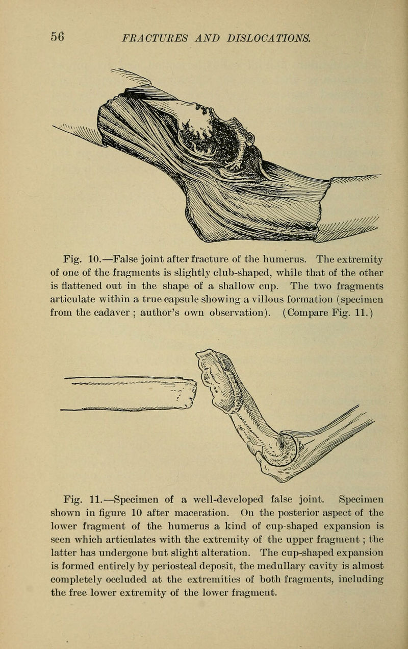 Fig. 10.—False joint after fracture of the humerus. The extremity of one of the fragments is slightly club-shaped, while that of the other is flattened out in the shape of a shallow cup. The two fragments articulate within a true capsule showing a villous formation (specimen from the cadaver ; author's own observation). (Compare Fig. 11.) Fig. 11.—Specimen of a well-developed false joint. Specimen shown in figure 10 after maceration. On the posterior aspect of the lower fragment of the humerus a kind of cup-shaped expansion is seen which articulates with the extremity of the upper fragment ; the latter has undergone but slight alteration. The cup-shaped expansion is formed entirely by periosteal deposit, the medullary cavity is almost completely occluded at the extremities of both fragments, including the free lower extremity of the lower fragment.