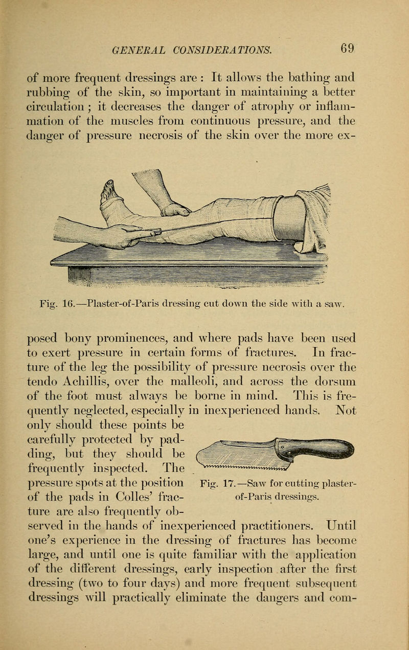 of more frequent dressings are : It allows the bathing and rubbing of the skin, so important in maintaining a better circulation ; it decreases the danger of atrophy or inflam- mation of the muscles from continuous pressure, and the danger of pressure necrosis of the skin over the more ex- Fig. 16.—Plaster-of-Paris dressing cut down the side with a saw. posed bony prominences, and where pads have been used to exert pressure in certain forms of fractures. In frac- ture of the leg the possibility of pressure necrosis over the tendo Achillis, over the malleoli, and across the dorsum of the foot must always be borne in mind. This is fre- quently neglected, especially in inexperienced hands. Not only should these points be carefully protected by pad- ding, but they should be frequently inspected. The pressure spots at the position of the pads in Colles' frac- ture are also frequently ob- served in the hands of inexperienced practitioners. Until one's experience in the dressing of fractures has become large, and until one is quite familiar with the application of the different dressings, early inspection . after the first dressing (two to four days) and more frequent subsequent dressings will practically eliminate the dangers and com- Fig. 17. —Saw for cutting plaster- of-Paris dressings.