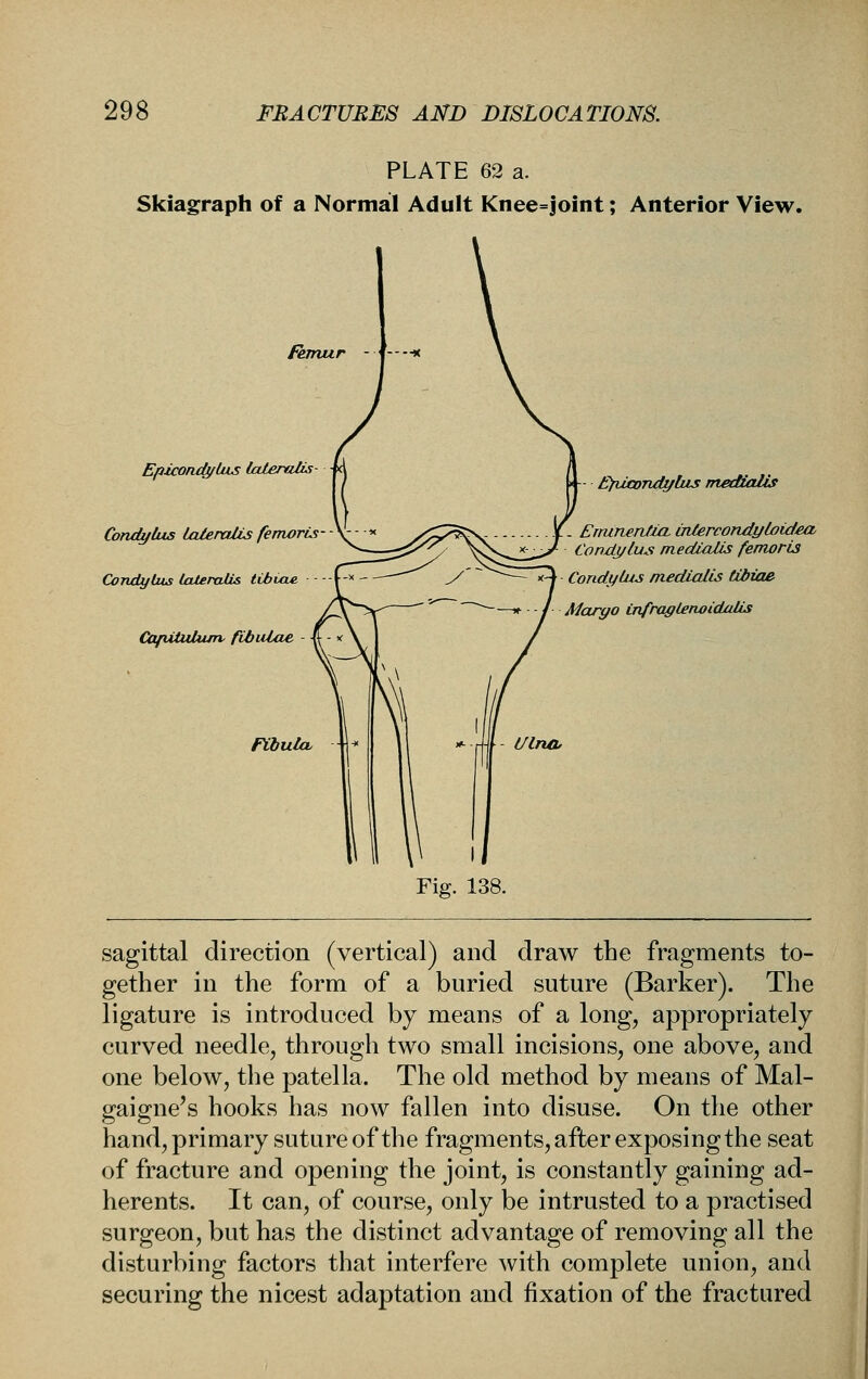 PLATE 62 a. Skiagraph of a Normal Adult Knee=joint; Anterior View. femur ----■»< Epiconcb/Uxs IcderaUs- Condylus laleraUs femorLs Condytus lateralis tibiae - Capituhun' fibulae Fibula. £)iia)ndz/lus mediaUs Ertunenfia, intercondyLoidea Conxiylus medlaUs femoris CondyLus medwlLs tibiae —* - / Maryo Cnfraylenoidcdis Ulna. Fig. 138. sagittal direction (vertical) and draw the fragments to- gether in the form of a buried suture (Barker). The ligature is introduced by means of a long, appropriately curved needle, through two small incisions, one above, and one below, the patella. The old method by means of Mal- gaigne's hooks has now fallen into disuse. On the other hand,primary suture of the fragments, after exposing the seat of fracture and opening the joint, is constantly gaining ad- herents. It can, of course, only be intrusted to a practised surgeon, but has the distinct advantage of removing all the disturbing factors that interfere with complete union, and securing the nicest adaptation and fixation of the fractured