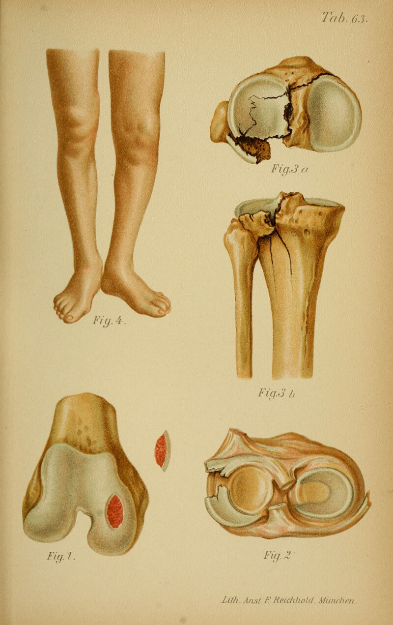 Fig A M fe Fic}.3 h Fnf.l. FifiZ Lith.An.st h:Reichhoid Miuirhct