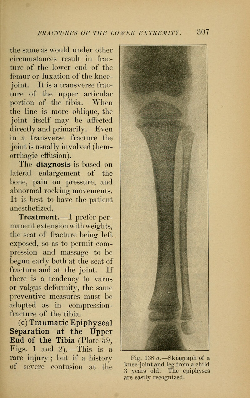 the same as would under other circumstances result in frac- ture of the lower end of the femur or luxation of the knee- joint. It is a transverse frac- ture of the upper articular portion of the tibia. When the line is more oblique, the joint itself may be affected directly and primarily. Even in a transverse fracture the joint is usually involved (hem- orrliagic effusion). The diagnosis is based on lateral enlargement of the bone, pain on pressure, and abnormal rocking movements. It is best to have the patient anesthetized. Treatment.—I prefer per- manent extension with weights, the seat of fracture being left exposed, so as to permit com- pression and massage to be begun early both at the seat of fracture and at the joint. If there is a tendency to varus or valgus deformity, the same preventive measures must be adopted as in compression- fracture of the tibia. (c) Traumatic Epiphyseal Separation at the Upper End of the Tibia (Plate 59, Figs. 1 and 2).—This is a rare injury ; but if a history of severe contusion at the Fig. 138 «.—Skiagraph of a knee-joint and leg from a child 3 years old. The epiphyses are easily recognized.