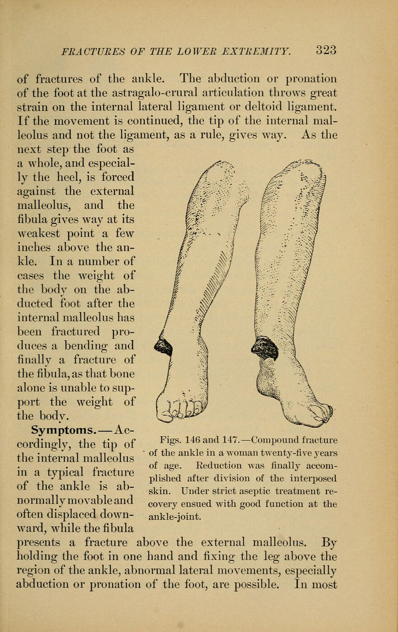 of fractures of the ankle. The abduction or pronation of the foot at the astragalo-crural articulation throws great strain on the internal lateral ligament or deltoid ligament. If the movement is continued^ the tip of the internal mal- leolus and not the ligament, as a rule, gives way. As the next step the foot as a whole, and especial- ^--•- ^^-^^^ ly the heel, is forced against the external malleolus, and the fibula gives way at its weakest point a few inches above the an- kle. In a number of cases the weight of the body on the ab- ducted foot after the internal malleolus has been fractured pro- duces a bending and finally a fracture of the fibula, as that bone alone is unable to sup- port the weight of the body. Symptoms.—Ac- cordingly, the tip of the internal malleolus in a typical fracture of the ankle is ab- normally movable and often displaced down- ward, while the fibula presents a fracture above the external malleolus. By holding the foot in one hand and fixing the leg above the region of the ankle, abnormal lateral movements, especially abduction or pronation of the foot, are possible. In most Figs. 146 and 147.—Compound fracture of the ankle in a woman twenty-five years of age. Reduction was finally accom- plished after division of the interposed skin. Under strict aseptic treatment re- covery ensued with good function at the ankle-joint.