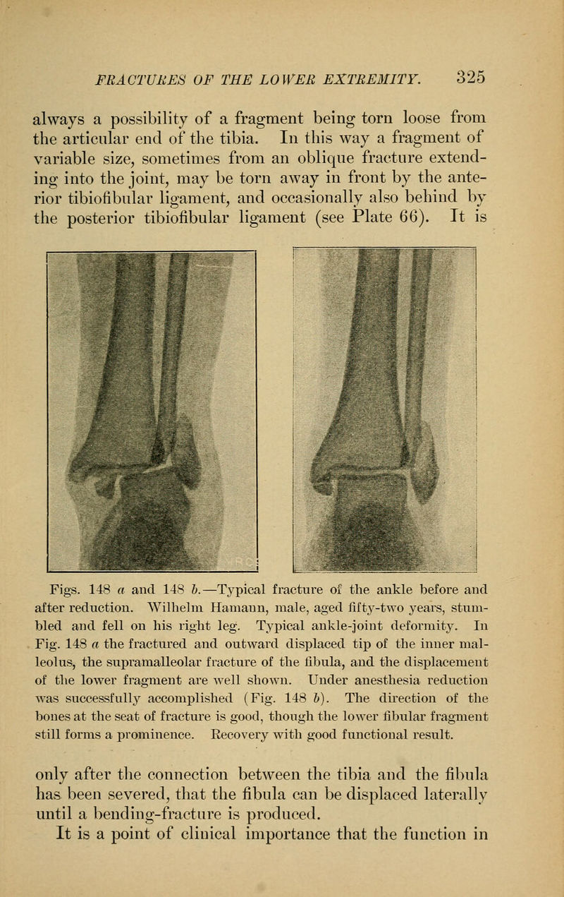always a possibility of a fragment being torn loose from the articular end of the tibia. In this way a fragment of variable size, sometimes from an oblique fracture extend- ing into the joint, may be torn away in front by the ante- rior tibiofibular ligament, and occasionally also behind by the posterior tibiofibular ligament (see Plate QQi). It is L Figs. 148 a and 148 h.—Typical fracture of the ankle before and after reduction. Wilhelm Hamann, male, aged iifty-two years, stum- bled and fell on his right leg. Typical ankle-joint deformity. In Fig. 148 a the fractured and outward displaced tip of the inner mal- leolus, the supramalleolar fracture of the fibula, and the displacement of the lower fragment are well shown. Under anesthesia reduction was successfully accomplished (Fig. 148 h). The direction of the bones at the seat of fracture is good, though the lower fibular fragment still forms a prominence. Recovery with good functional result. only after tlie connection between the tibia and the fibula has been severed, that the fibula can be displaced laterally until a bending-fracture is produced. It is a point of clinical importance that the function in