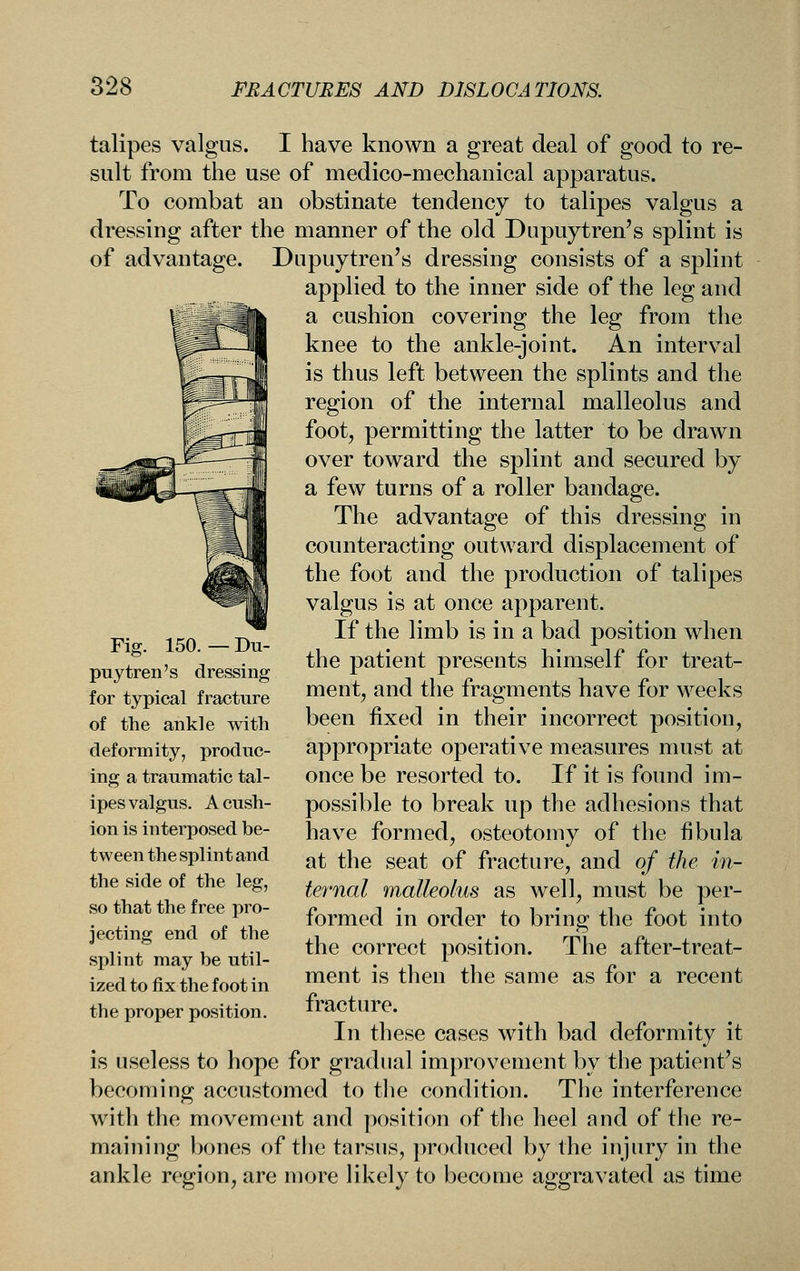 talipes valgus. I have known a great deal of good to re- sult from the use of medico-mechanical apparatus. To combat an obstinate tendency to talipes valgus a dressing after the manner of the old Dupuytren's splint is of advantage. Dupuytren's dressing consists of a splint applied to the inner side of the leg and a cushion covering the leg from the knee to the ankle-joint. An interval is thus left between the splints and the region of the internal malleolus and foot, permitting the latter to be drawn over toward the splint and secured by a few turns of a roller bandage. The advantage of this dressing in counteracting outward displacement of the foot and the production of talipes valgus is at once apparent. If the limb is in a bad position when the patient presents himself for treat- ment, and the fragments have for weeks been fixed in their incorrect position, appropriate operative measures must at once be resorted to. If it is found im- possible to break up the adhesions that have formed, osteotomy of the fibula at the seat of fracture, and of the in- ternal malleolus as well, must be per- formed in order to bring the foot into the correct position. The after-treat- ment is then the same as for a recent fracture. In these cases with bad deformity it is useless to hope for gradual improvement by the patient's becoming accustomed to the condition. The interference with the movement and position of the heel and of the re- maining bones of the tarsus, produced by the injury in the ankle region, are more likely to become aggravated as time Fig. 150. — Du- puytren's dressing for typical fracture of the ankle with deformity, produc- ing a traumatic tal- ipes valgus. A cush- ion is interposed be- tween the splint and the side of the leg, so that the free pro- jecting end of the splint may be util- ized to fix the foot in the proper position.