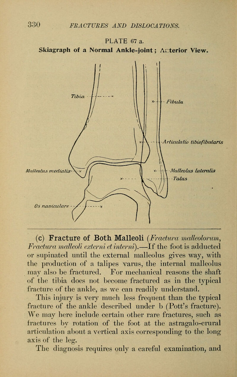 PLATE 67 a. Skiagraph of a Normal Ankle=joint; Anterior View. Tibia, MnJiwUts medicUis- Os naoiculare Fibida ■Articalatio tibCofibiUaris MaHaolus LaleraUs TaUis (c) Fracture of Both Malleoli {Fradura malleolorum, Fractmxt malleoli externi el inter ni).—If the foot is add acted or supinated until the external malleolus gives way, with the production of a talipes varus, the internal malleolus may also be fractured. For mechanical reasons the shaft of the tibia does not become fractured as in the typical fracture of the ankle, as we can readily understand. This injury is very much less frequent than the typical fracture of the ankle described under b (Pottos fracture). AVe may here include certain other rare fractures, such as fractures by rotation of the foot at the astragalo-crural articulation about a vertical axis corresponding to the long axis of the leg. The diagnosis requires only a careful examination, and