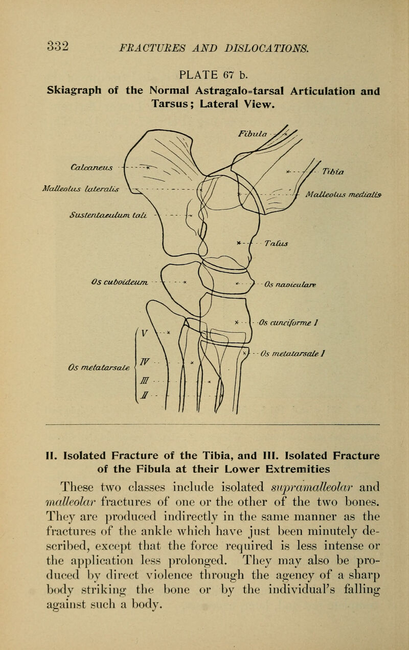 PLATE 67 b. Skiagraph of the Normal AstragaIo=tarsal Articulation and Tarsus; Lateral View. CaicaneiLs Malleolus laleralis SustenloMiltun taU Os cuboUteum Os mefatarscble TiJiia MaileoULs meduzlis Os ncLoiculare y^ \- Os cunciforme 1 Os melatarsale J II. Isolated Fracture of the Tibia, and III. Isolated Fracture of the Fibula at their Lower Extremities These two classes include isolated supramalleolar and malleolar fractures of one or the other of the two bones. They are produced indirectly in the same manner as the fractures of the ankle which have just been minutely de- scribed, except that the force required is less intense or the application less prolonged. They may also be pro- duced by direct violence through the agency of a sharp body striking the bone or by the individuaFs falling against such a body.