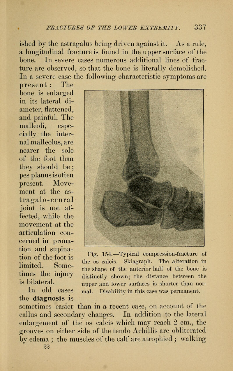 ished by the astragalus being driven against it. As a rule, a longitudinal fracture is found in the upper surface of the bone. In severe cases numerous additional lines of frac- ture are observed, so that the bone is literally demolished. In a severe case the following characteristic symptoms are present : The bone is enlarged in its lateral di- ameter, flattened, and painful. The malleoli, espe- cially the inter- nal malleolus, are nearer the sole of the foot than they should be; pes planus is often present. Move- ment at the as- tragalo-crural joint is not af- fected, while the movement at the articulation con- cerned in prona- tion and supina- tion of the foot is limited. Some- times the injury is bilateral. In old cases the diagnosis is sometimes easier than in a recent case, on account of the callus and secondary changes. In addition to the lateral enlargement of the os calcis which may reach 2 cm., the grooves on either side of the tendo Achillis are obliterated by edema ; the muscles of the calf are atrophied ; walking 33 Fig. 154.—Typical compression-fracture of the OS calcis. Skiagraph. The alteration in the shape of the anterior half of the bone is distinctly shown; the distance between the upper and lower surfaces is shorter than nor- mal. Disability in this case was permanent.