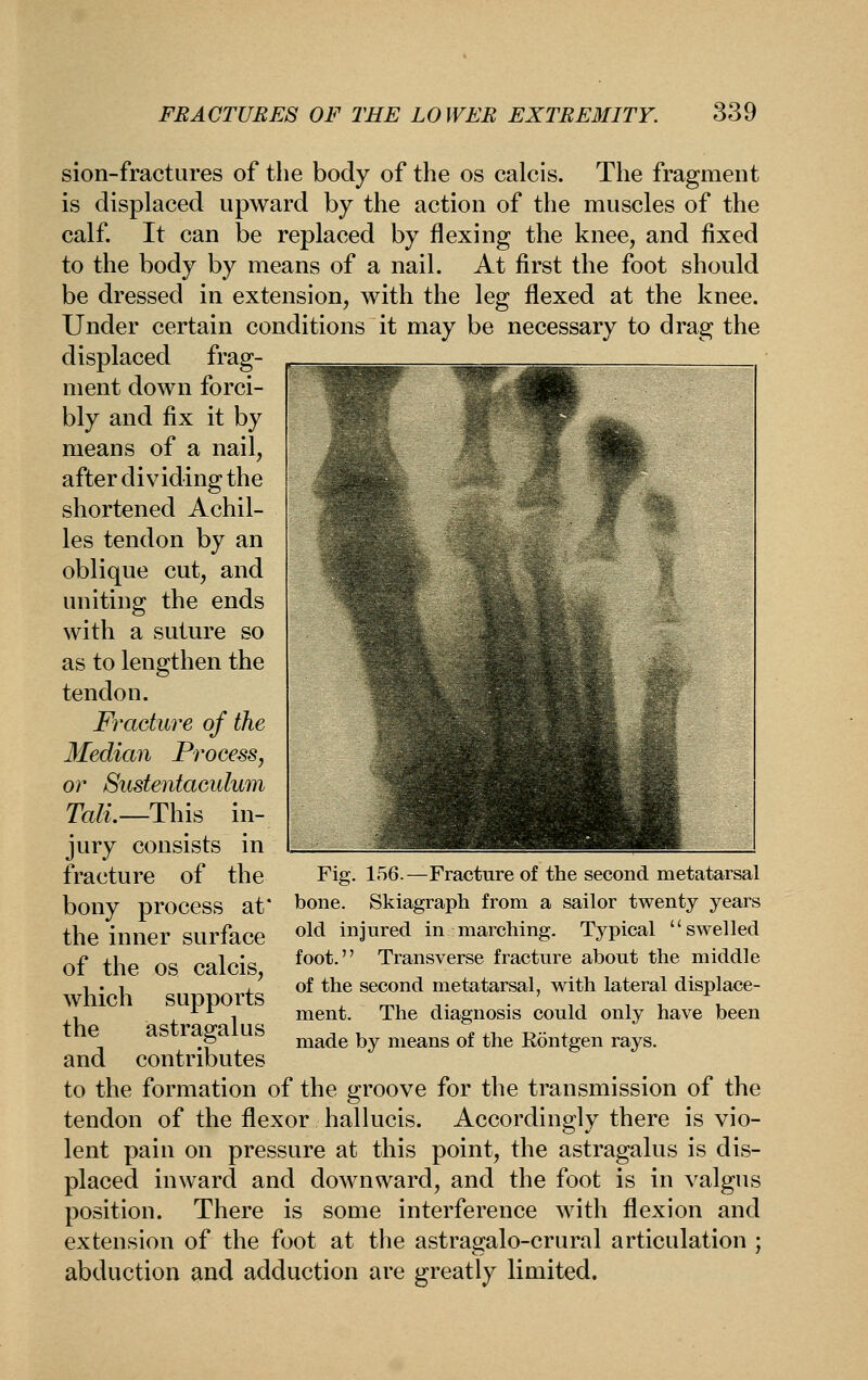 sion-fractures of the body of the os calcis. The fragment is displaced upward by the action of the muscles of the calf. It can be replaced by flexing the knee, and fixed to the body by means of a nail. At first the foot should be dressed in extension, with the leg flexed at the knee. Under certain conditions it may be necessary to drag the displaced frag- , __^__^^^ ment down forci- bly and fix it by means of a nail, after dividing the shortened Achil- les tendon by an oblique cut, and uniting the ends with a suture so as to lengthen the tendon. Fracture of the Median Pi^ocess, or Sustentaculum Tali.—Thi^ in- jury consists in fracture of the bony process at the inner surface of the OS calcis, which supports the astragalus and contributes Fig. 156.—Fracture of the second metatarsal bone. Skiagraph from a sailor twenty years old injured in marching. Typical swelled foot. Transverse fracture about the middle of the second metatarsal, with lateral displace- ment. The diagnosis could only have been made by means of the Rontgen rays. to the formation of the groove for the transmission of the tendon of the flexor hallucis. Accordingly there is vio- lent pain on pressure at this point, the astragalus is dis- placed inward and downward, and the foot is in valgus position. There is some interference with flexion and extension of the foot at the astragalo-crural articulation ; abduction and adduction are greatly limited.