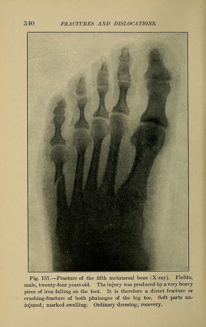 Fig. 157.—Fracture of the fifth metatarsal bone (X-ray). Fielitz, male, twenty-four years old. The injury was produced by a very heavy piece of iron falling on the foot. It is therefore a direct fracture or crushing-fracture of both phalanges of the big toe. Soft parts un- injured; marked swelling. Ordinary dressing; recovery.