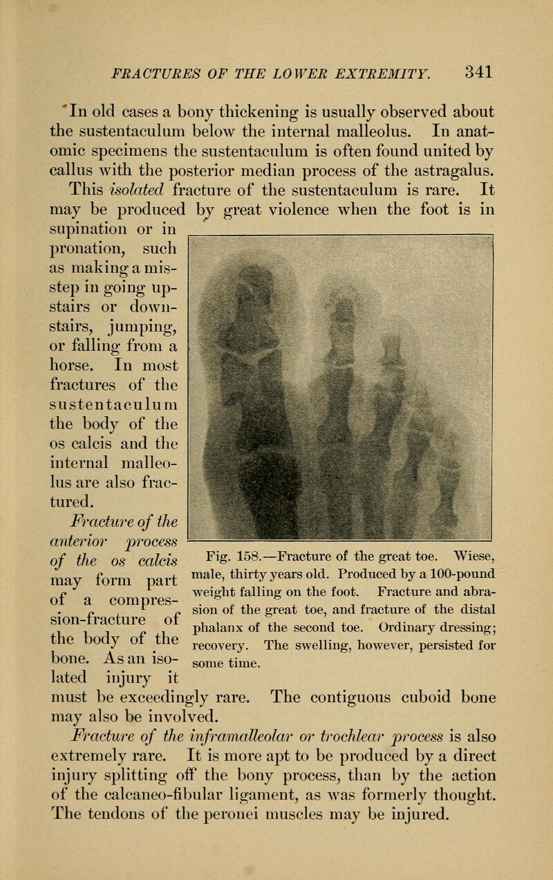 'In old cases a bony thickening is usually observed about the sustentaculum below the internal malleolus. In anat- omic specimens the sustentaculum is often found united by callus with the posterior median process of the astragalus. This isolated fracture of the sustentaculum is rare. It may be produced by great violence when the foot is in supination or in pronation, such as making a mis- step in going up- stairs or down- stairs, jumping, or falling from a horse. In most fractures of the sustentaculum the body of the OS calcis and the internal malleo- lus are also frac- tured. Fracture of the anterior process of the OS calcis may form part of a compres- sion-fracture of the body of the bone. As an iso- lated injury it must be exceedingly rare, may also be involved. Fracture of the inframalleolar or trochlear process is also extremely rare. It is more apt to be produced by a direct injury splitting off the bony process, than by the action of the calcaneo-fibular ligament, as was formerly thought. The tendons of the peronei muscles may be injured. Fig. 158.—Fracture of the great toe. Wiese, male, thirty years old. Produced by a 100-pound weight falling on the foot. Fracture and abra- sion of the great toe, and fracture of the distal phalanx of the second toe. Ordinary dressing; recovery. The swelling, however, persisted for some time. The contiguous cuboid bone