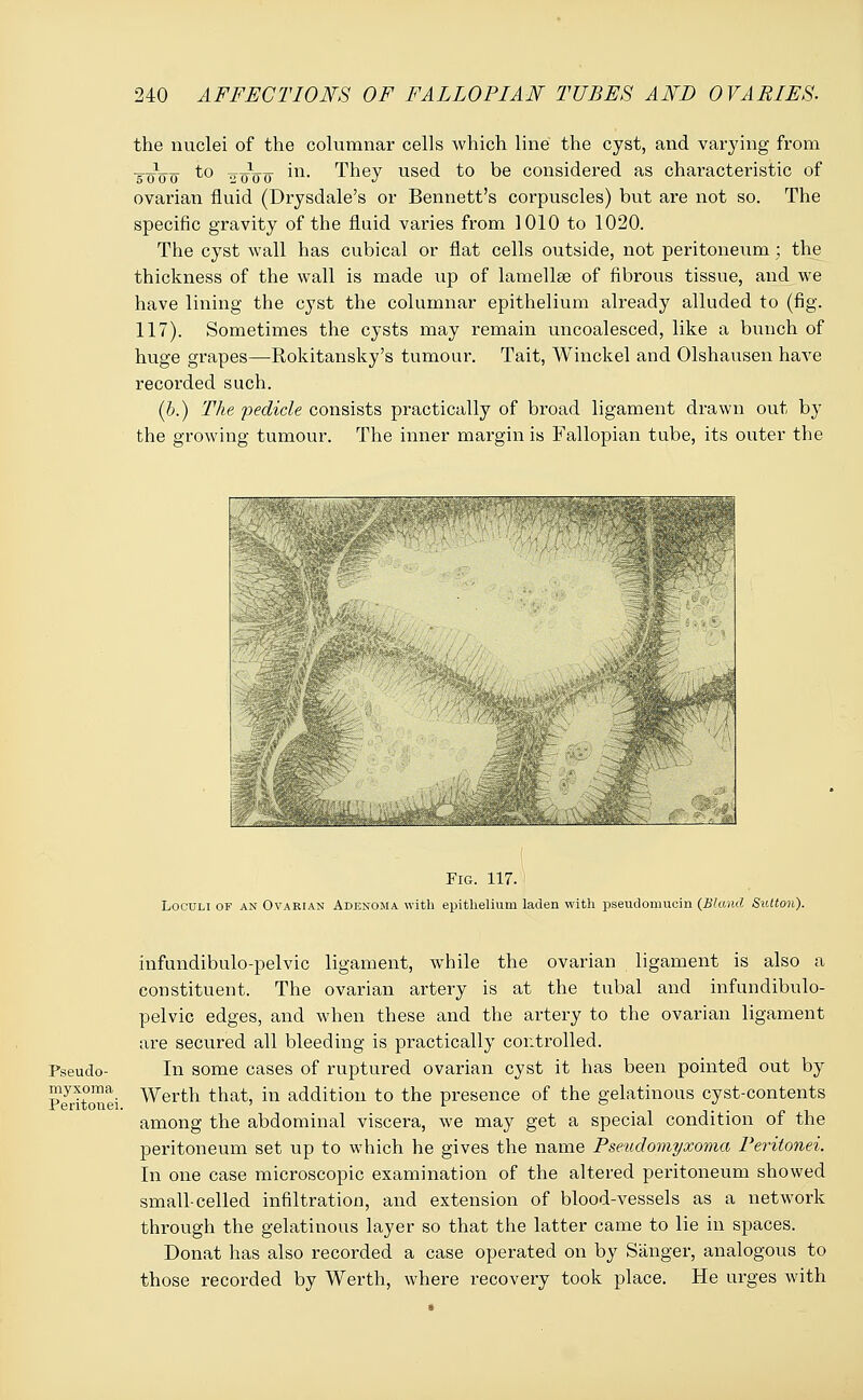 the nuclei of the columnar cells which line the cyst, and varying from .g.-1-- to 20V0 m- They used to be considered as characteristic of ovarian fluid (Drysdale's or Bennett's corpuscles) but are not so. The specific gravity of the fluid varies from 1010 to 1020. The cyst wall has cubical or flat cells outside, not peritoneum; the thickness of the wall is made up of lamellae of fibrous tissue, and we have lining the cyst the columnar epithelium already alluded to (fig. 117). Sometimes the cysts may remain uncoalesced, like a bunch of huge grapes—Rokitansky's tumour. Tait, Winckel and Olshausen have recorded such. (b.) The pedicle consists practically of broad ligament drawn out by the growing tumour. The inner margin is Fallopian tube, its outer the .„_____ Fig. 117. Loculi of an Ovarian Adenoma with epithelium laden with pseudomucin (Bland Sutton). Pseudo- myxoma Peritonei. infundibulo-pelvic ligament, while the ovarian ligament is also a constituent. The ovarian artery is at the tubal and infundibulo- pelvic edges, and when these and the artery to the ovarian ligament are secured all bleeding is practically controlled. In some cases of ruptured ovarian cyst it has been pointed out by Werth that, in addition to the presence of the gelatinous cyst-contents among the abdominal viscera, we may get a special condition of the peritoneum set up to which he gives the name Pseudomyxoma Peritonei. In one case microscopic examination of the altered peritoneum showed small-celled infiltration, and extension of blood-vessels as a network through the gelatinous layer so that the latter came to lie in spaces. Donat has also recorded a case operated on by Sanger, analogous to those recorded by Werth, where recovery took place. He urges with