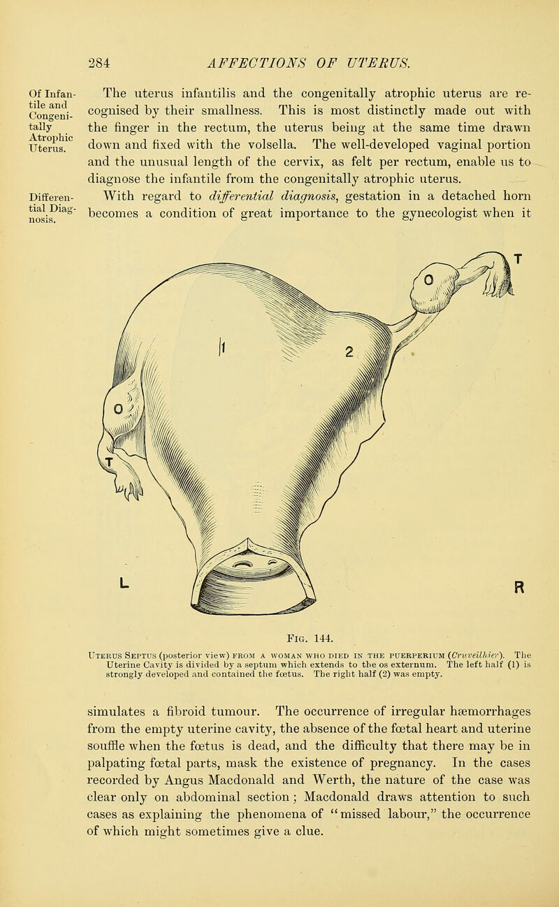 Of Infan- tile and Congeni- tally Atrophic Uterus. Differen- tial Diag- nosis. The uterus infantilis and the congenitally atrophic uterus are re- cognised by their smallness. This is most distinctly made out with the finger in the rectum, the uterus being at the same time drawn down and fixed with the volsella. The well-developed vaginal portion and the unusual length of the cervix, as felt per rectum, enable us to diagnose the infantile from the congenitally atrophic uterus. With regard to differential diagnosis, gestation in a detached horn becomes a condition of great importance to the gynecologist when it R Fig. 144. Uterus Septus (posterior view) from a woman who died in the puerperium {CruveilhMr). The Uterine Cavity is divided by a septum which extends to the os externum. The left half (1) is strongly developed and contained the fcetus. The right half (2) was empty. simulates a fibroid tumour. The occurrence of irregular hgemorrhages from the empty uterine cavity, the absence of the foetal heart and uterine souffle when the fcetus is dead, and the difficulty that there may be in palpating foetal parts, mask the existence of pregnancy. In the cases recorded by Angus Macdonald and Werth, the nature of the case was clear only on abdominal section; Macdonald draws attention to such cases as explaining the phenomena of missed labour, the occurrence of which might sometimes give a clue.