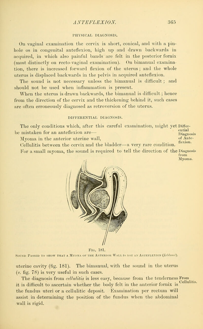 PHYSICAL DIAGNOSIS. On vaginal examination the cervix is short, conical, and with a pin- hole os in congenital anteflexion, high up and drawn backwards in acquired, in which also painful bands are felt in the posterior fornix (most distinctly on recto-vaginal examination). On bimanual examina- tion, there is increased forward flexion of the uterus; and the whole uterus is displaced backwards in the pelvis in acquired anteflexion. The sound is not necessary unless the bimanual is difficult; and should not be used when inflammation is present. When the uterus is drawn backwards, the bimanual is difficult; hence from the direction of the cervix and the thickening behind it, such cases are often erroneously diagnosed as retroversion of the uterus. DIFFERENTIAL DIAGNOSIS. The only conditions which, after this careful examination, might yet Differ- ential Diagnosis of Ante- Cellulitis between the cervix and the bladder—a very rare condition. For a small myoma, the sound is required to tell the direction of the Diagnosis from Myoma. be mistaken for an anteflexion are— Myoma in the anterior uterine wall, Fig. 181. Sound Passed to show that a Myoma of the Anterior Wall is not an Anteflexion (Leblomt). uterine cavity (fig. 181). The bimanual, with the sound in the uterus (v. fig. 78) is very useful in such cases. The diagnosis from cellulitis is less easy, because from the tenderness From it is difficult to ascertain whether the body felt in the anterior fornix is the fundus uteri or a cellulitic deposit. Examination per rectum will assist. in determining the position of the fundus when the abdominal wall is rigid.