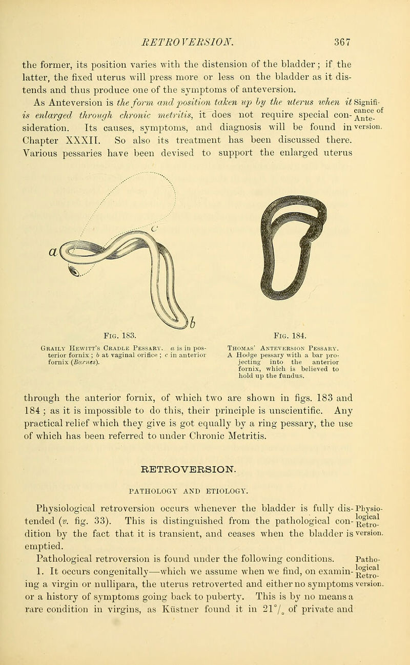 the former, its position varies with the distension of the bladder; if the latter, the fixed uterus will press more or less on the bladder as it dis- tends and thus produce one of the symptoms of anteversion. As Anteversion is the form and %>ositio7i taken up by the uterus tvhen it Signifi- es enlarged through chronic metritis, it does not require special con-^1^6.0 sideration. Its causes, symptoms, and diagnosis will be found inversion. Chapter XXXII. So also its treatment has been discussed there. Various pessaries have been devised to support the enlarged uterus Fig. 183. Gbaily Hewitt's Cradle Pessary, a, is in pos- terior fornix ; b at vaginal orifice ; c in anterior fornix (Barnes). Fig. 184. Thomas' Anteversion Pessary. A Hodge pessary with a bar pro- jecting into the anterior fornix, which is believed to hold up the fundus. through the anterior fornix, of which two are shown in figs. 183 and 184 ; as it is impossible to do this, their principle is unscientific. Any practical relief which they give is got equally by a ring pessary, the use of which has been referred to under Chronic Metritis. RETROVERSION. PATHOLOGY AND ETIOLOGY. Physiological retroversion occurs whenever the bladder is fully dis- tended (v. fig. 33). This is distinguished from the pathological con- dition by the fact that it is transient, and ceases when the bladder is emptied. Pathological retroversion is found under the following conditions. 1. It occurs congenitally—which we assume when we find, on examin- ing a virgin or nullipara, the uterus retroverted and either no symptoms or a history of symptoms going back to puberty. This is by no means a rare condition in virgins, as Kiistner found it in 21°/o of private and Physio- logical Retro- version. Patho- logical Retro- version.