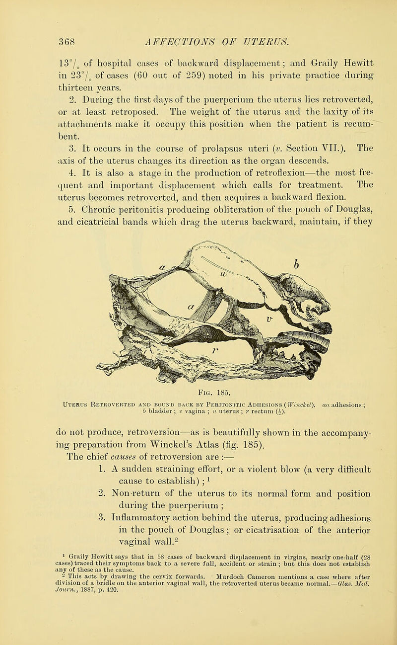 13°/o of hospital cases of backward displacement; and Graily Hewitt in 23°/o of cases (60 out of 259) noted in his private practice during thirteen years. 2. During the first days of the puerperium the uterus lies retroverted, or at least retroposed. The weight of the uterus and the laxity of its attachments make it occupy this position when the patient is recum- bent. 3. It occurs in the course of prolapsus uteri (v. Section VII.). The axis of the uterus changes its direction as the organ descends. 4. It is also a stage in the production of retroflexion—the most fre- quent and important displacement which calls for treatment. The uterus becomes retroverted, and then acquires a backward flexion. 5. Chronic peritonitis producing obliteration of the pouch of Douglas, and cicatricial bands which drag the uterus backward, maintain, if they Fig. 185. Uterus Retroverted and bound back by Peritonitic Adhesions (Wlnckel). act adhesions ; b bladder ; v vagina ; u uterus ; r rectum (t). do not produce, retroversion—as is beautifully shown in the accompany- ing preparation from Winckel's Atlas (fig. 185). The chief causes of retroversion are :— 1. A sudden straining effort, or a violent blow (a very difficult cause to establish);l 2. Non-return of the uterus to its normal form and position during the puerperium; 3. Inflammatory action behind the uterus, producing adhesions in the pouch of Douglas; or cicatrisation of the anterior vaginal wall.2 1 Graily Hewitt says that in 5S cases of backward displacement in virgins, nearly one-half (28 cases) traced their symptoms back to a severe fall, accident or strain; but this does not establish any of these as the cause. - This acts by drawing the cervix forwards. Murdoch Cameron mentions a case where after division of a bridle on the anterior vaginal wall, the retroverted uterus became normal.—Glas. Mtd. Journ., 1837, p. 420.