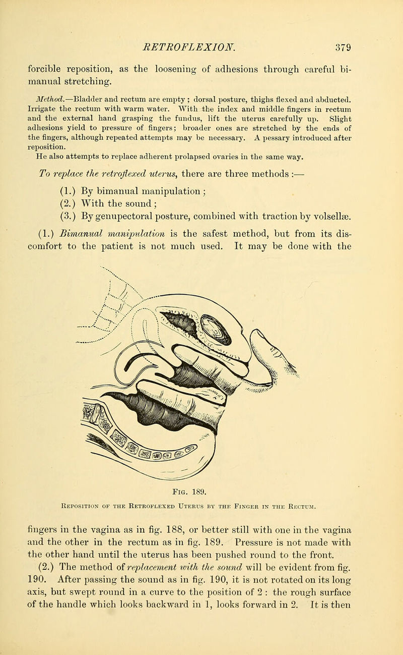 forcible reposition, as the loosening of adhesions through careful bi- manual stretching. Method.—Bladder and rectum are empty ; dorsal posture, thighs flexed and abducted. Irrigate the rectum with warm water. With the index and middle fingers in rectum and the external hand grasping the fundus, lift the uterus carefully up. Slight adhesions yield to pressure of fingers; broader ones are stretched by the ends of the fingers, although repeated attempts may be necessary. A pessary introduced after reposition. He also attempts to replace adherent prolapsed ovaries in the same way. To replace the retrqflexed uterus, there are three methods :— (1.) By bimanual manipulation • (2.) With the sound; (3.) By genupectoral posture, combined with traction by volsellse. (1.) Bimanual manipulation is the safest method, but from its dis- comfort to the patient is not much used. It may be done with the Fig. 189. Reposition of the Retrqflexed Uterus by the Finger in the Rectum. fingers in the vagina as in fig. 188, or better still with one in the vagina and the other in the rectum as in fig. 189. Pressure is not made with the other hand until the uterus has been pushed round to the front. (2.) The method of replacement with the sound will be evident from fig. 190. After passing the sound as in fig. 190, it is not rotated on its long axis, but swept round in a curve to the position of 2 : the rough surface of the handle which looks backward in 1, looks forward in 2. It is then