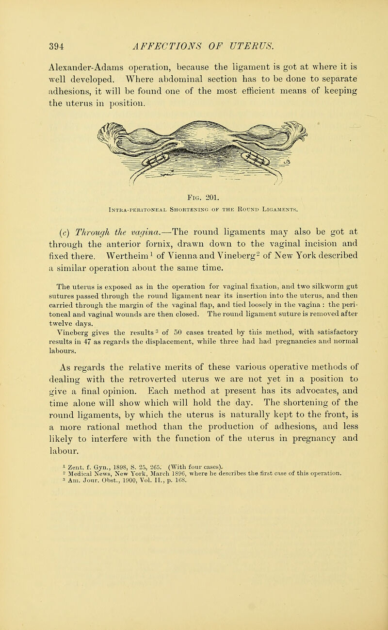 Alexander-Adams operation, because the ligament is got at where it is well developed. Where abdominal section has to be done to separate adhesions, it will be found one of the most efficient means of keeping the uterus in position. Fig. 201. INTRA-PERITONEAL SHORTENING OF THE ROUND LIGAMENTS. (c) Through the vagina.—The round ligaments may also be got at through the anterior fornix, drawn down to the vaginal incision and fixed there. Wertheim1 of Vienna and Vineberg2 of New York described a similar operation about the same time. The uterus is exposed as in the operation for vaginal fixation, and two silkworm gut sutures passed through the round ligament near its insertion into the uterus, and then carried through the margin of the vaginal flap, and tied loosely in the vagina : the peri- toneal and vaginal wounds are then closed. The round ligament suture is removed after twelve days. Vineberg gives the results3 of 50 cases treated by this method, with satisfactory results in 47 as regards the displacement, while three had had pregnancies and normal labours. As regards the relative merits of these various operative methods of dealing with the retroverted uterus we are not yet in a position to give a final opinion. Each method at present has its advocates, and time alone will show which will hold the day. The shortening of the round ligaments, by which the uterus is naturally kept to the front, is a more rational method than the production of adhesions, and less likely to interfere with the function of the uterus in pregnancy and labour. 1 Zent. f. Gyn., 1898, S. 25, 265. (With four cases).  Medical News, New York, March 189G, where he describes the first case of this operation. 3 Am. Jour. Obst., 1900, Vol. II., p. 16S.