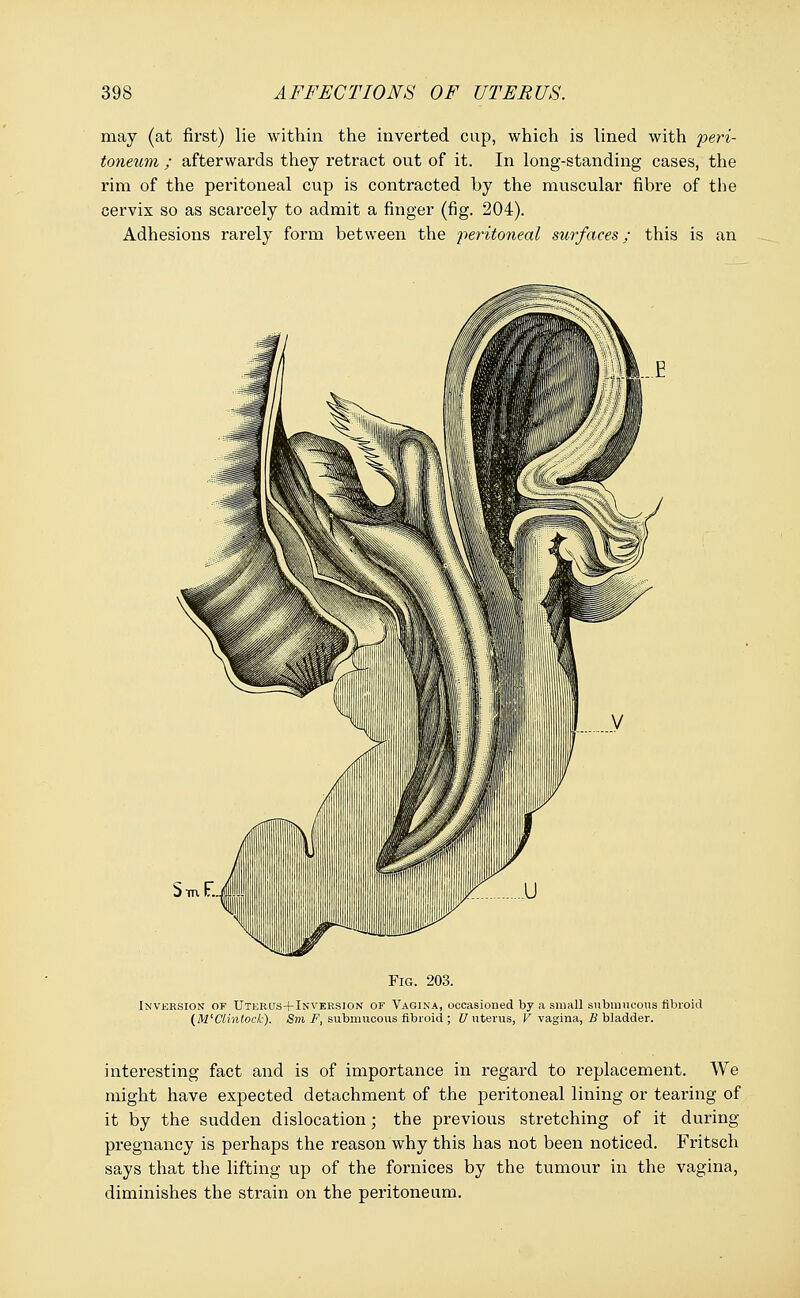 may (at first) lie within the inverted cup, which is lined with peri- toneum ; afterwards they retract out of it. In long-standing cases, the rim of the peritoneal cup is contracted by the muscular fibre of the cervix so as scarcely to admit a finger (fig. 204). Adhesions rarely form between the jteritoneal surfaces; this is an bm Fig. 203. Inversion of Utercjs+Inversion of Vagina, occasioned by a small submucous fibroid (M'Clintock). Sm F, submucous fibroid ; U uterus, V vagina, B bladder. interesting fact and is of importance in regard to replacement. We might have expected detachment of the peritoneal lining or tearing of it by the sudden dislocation; the previous stretching of it during pregnancy is perhaps the reason why this has not been noticed. Fritsch says that the lifting up of the fornices by the tumour in the vagina, diminishes the strain on the peritoneum.