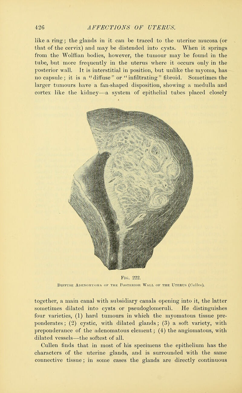 like a ring; the glands in it can be traced to the uterine mucosa (or that of the cervix) and may be distended into cysts. When it springs from the Wolffian bodies, however, the tumour may be found in the tube, but more frequently in the uterus where it occurs only in the posterior wall. It is interstitial in position, but unlike the myoma, has no capsule; it is a diffuse  or  infiltrating fibroid. Sometimes the larger tumours have a fan-shaped disposition, showing a medulla and cortex like the kidney—a system of epithelial tubes placed closely Fig. 222. Diffuse Adenomyoma of the Posterior Wall of the Uterus (Cullen). together, a main canal with subsidiary canals opening into it, the latter sometimes dilated into cysts or pseudoglomeruli. He distinguishes four varieties, (1) hard tumours in which the myomatous tissue pre- ponderates ; (2) cystic, with dilated glands; (3) a soft variety, with preponderance of the adenomatous element; (4) the angiomatous, with dilated vessels—the softest of all. Cullen finds that in most of his specimens the epithelium has the characters of the uterine glands, and is surrounded with the same connective tissue; in some cases the glands are directly continuous