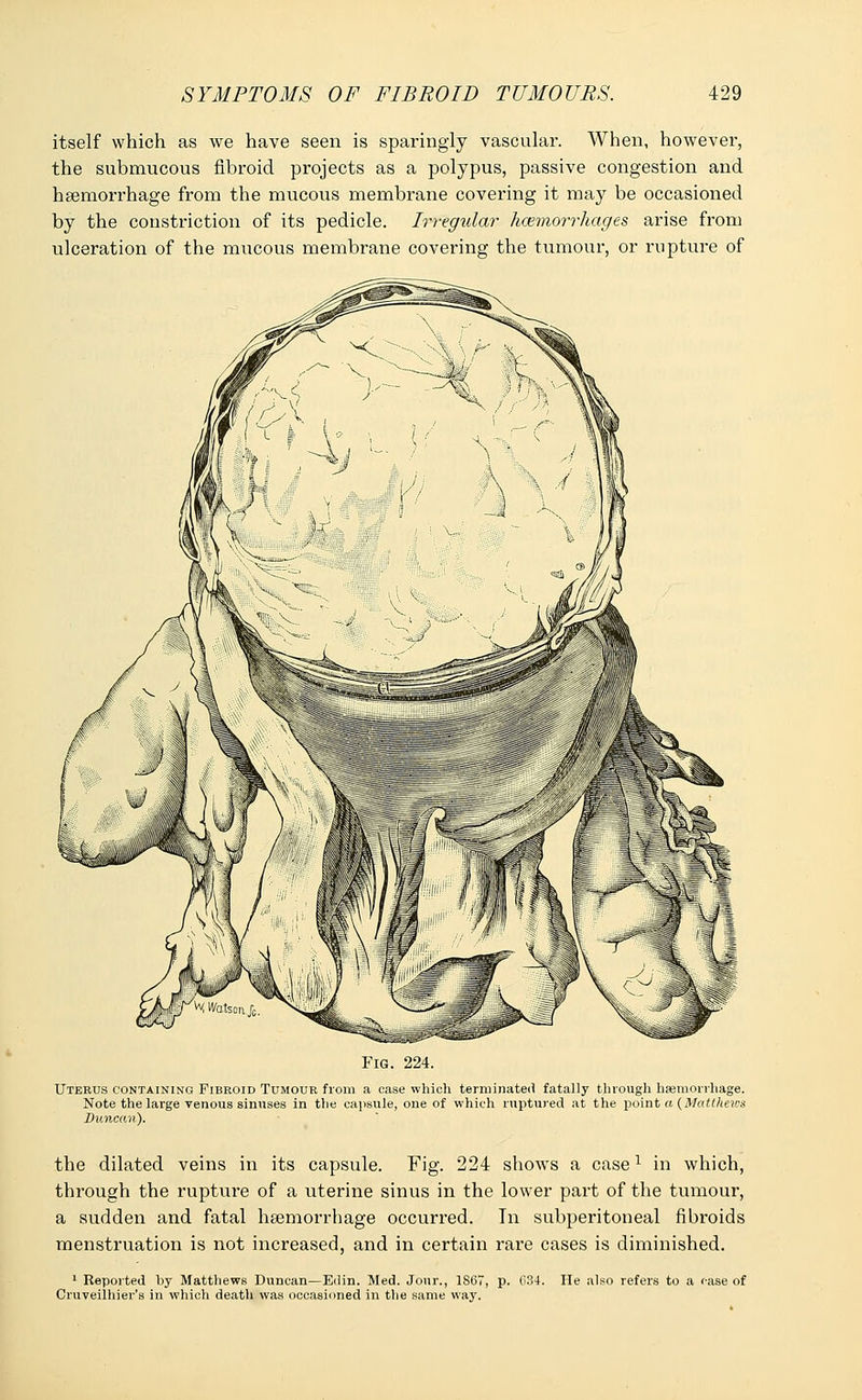 itself which as we have seen is sparingly vascular. When, however, the submucous fibroid projects as a polypus, passive congestion and haemorrhage from the mucous membrane covering it may be occasioned by the constriction of its pedicle. Irregular haemorrhages arise from ulceration of the mucous membrane covering the tumour, or rupture of Fig. 224. Uterus containing Fibroid Tumour from a case which terminated fatally through haemorrhage. Note the large venous sinuses in the capsule, one of which ruptured at the point a (Matthews Duncan). the dilated veins in its capsule. Fig. 224 shows a case1 in which, through the rupture of a uterine sinus in the lower part of the tumour, a sudden and fatal haemorrhage occurred. In subperitoneal fibroids menstruation is not increased, and in certain rai-e cases is diminished. 1 Reported by Matthews Duncan—Edin. Med. Jour., 1867, p. 034. He also refers to a case of Cruveilhier's in which death was occasioned in the same way.