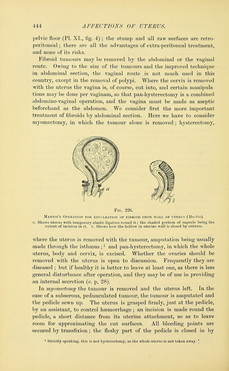 pelvic floor (PL XL, fig. 4); the stump and all raw surfaces are retro- peritoneal • there are all the advantages of extra-peritoneal treatment, and none of its risks. Fibroid tumours may be removed by the abdominal or the vaginal route. Owing to the size of the tumours and the improved technique in abdominal section, the vaginal route is not much used in this country, except in the removal of polypi. Where the cervix is removed with the uterus the vagina is, of course, cut into, and certain manipula- tions may be done per vaginam, so that pan-hysterectomy is a combined abdominovaginal operation, and the vagina must be made as aseptic beforehand as the abdomen. We consider first the more important treatment of fibroids by abdominal section. Here we have to consider myomectomy, in which the tumour alone is removed; hysterectomy, Fig. 220. Martin's Operation for enucleation of fibroid from wall of uterus (Martin). ii. Shows uterus with temporary elastic ligature round it; the shaded portion of capsule being the extent of incision in it. b. Shows how the hollow in uterine wall is closed by sutures. where the uterus is removed with the tumour, amputation being usually made through the isthmus ;1 and pan-hysterectomy, in which the whole uterus, body and cervix, is excised. Whether the ovaries should be removed with the uterus is open to discussion. Frequently they are diseased ; but if healthy it is better to leave at least one, as there is less general disturbance after operation, and they may be of use in providing an internal secretion (v. p. 28). In myomectomy the tumour is removed and the uterus left. In the case of a subserous, pedunculated tumour, the tumour is amputated and the pedicle sewn up. The uterus is grasped fh*mly, just at the pedicle, by an assistant, to control haemorrhage; an incision is made round the pedicle, a short distance from its uterine attachment, so as to leave room for approximating the cut surfaces, All bleeding points are secured by transfixion; the fleshy part of the pedicle is closed in by 1 Strictly speaking, this is not hysterectomy, as the whole uterus is not taken away.