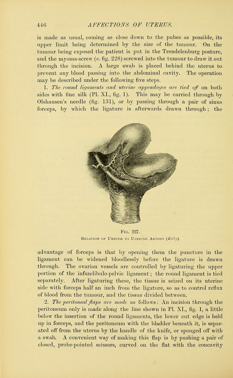 is made as usual, coming as close down to the pubes as possible, its upper limit being determined by the size of the tumour. On the tumour being exposed the patient is put in the Trendelenburg posture, and the myoma-screw (v. fig. 228) screwed into the tumour to draw it out through the incision. A large swab is placed behind the uterus to prevent any blood passing into the abdominal cavity. The operation may be described under the following five steps. 1. The round ligaments and uterine appendages are tied off on both sides with fine silk (PI. XL, fig. 1). This may be carried through by Olshausen's needle (fig. 131), or by passing through a pair of sinus forceps, by which the ligature is afterwards drawn through; the _«aB88gatefc, Fig. 227. Relation of Ureter to Uterine Artery (Kelly). advantage of forceps is that by opening them the puncture in the ligament can be widened bloodlessly before the ligature is drawn through. The ovarian vessels are controlled by ligaturing the upper portion of the infundibulo-pelvic ligament; the round ligament is tied separately. After ligaturing these, the tissue is seized on its uterine side with forceps half an inch from the ligature, so as to control reflux of blood from the tumour, and the tissue divided between. 2. The peritoneal flaps are made as follows: An incision through the peritoneum only is made along the line shown in PI. XL, fig. 1, a little below the insertion of the round ligaments, the lower cut edge is held up in forceps, and the peritoneum with the bladder beneath it, is separ- ated off from the uterus by the handle of the knife, or sponged off with a swab. A convenient way of making this flap is by pushing a pair of closed, probe-pointed scissors, curved on the flat with the concavity