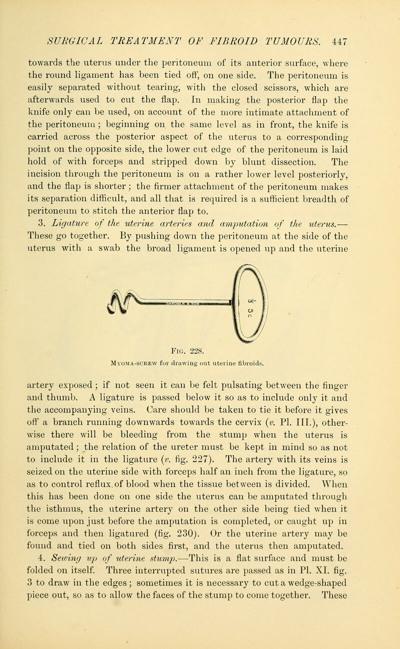 towards the uterus under the peritoneum of its anterior surface, where the round ligament has been tied off, on one side. The peritoneum is easily separated without tearing, with the closed scissors, which are afterwards used to cut the flap. In making the posterior flap the knife only can be used, on account of the more intimate attachment of the peritoneum; beginning on the same level as in front, the knife is carried across the posterior aspect of the uterus to a corresponding- point on the opposite side, the lower cut edge of the peritoneum is laid hold of with forceps and stripped down by blunt dissection. The incision through the peritoneum is on a rather lower level posteriorly, and the flap is shorter; the firmer attachment of the peritoneum makes its separation difficult, and all that is required is a sufficient breadth of peritoneum to stitch the anterior flap to. 3. Ligature of the uterine arteries and amputation of the uterus.— These go together. By pushing down the peritoneum at the side of the uterus with a swab the broad ligament is opened up and the uterine Fig. 228. Myoma-screw for drawing out uterine fibroids. artery exposed; if not seen it can be felt pulsating between the finger and thumb. A ligature is passed below it so as to include only it and the accompanying veins. Care should be taken to tie it before it gives off a branch running downwards towards the cervix (v. PL III.), other- wise there will be bleeding from the stump when the uterus is amputated; the relation of the ureter must be kept in mind so as not to include it in the ligature (v. fig. 227). The artery with its veins is seized on the uterine side with forceps half an inch from the ligature, so as to control reflux.of blood when the tissue between is divided. When this has been done on one side the uterus can be amputated through the isthmus, the uterine artery on the other side being tied when it is come upon just before the amputation is completed, or caught up in forceps and then ligatured (fig. 230). Or the uterine artery may be found and tied on both sides first, and the uterus then amputated. 4. Sewing ujj of uterine stump.—This is a flat surface and must be folded on itself. Three interrupted sutures are passed as in PI. XI. fig. 3 to draw in the edges; sometimes it is necessary to cut a wedge-shaped piece out, so as to allow the faces of the stump to come together. These