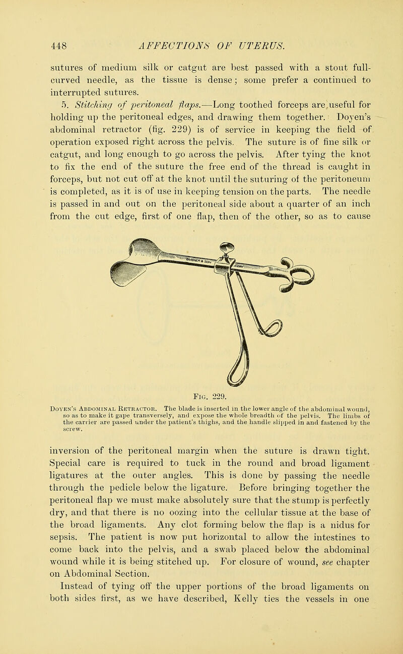 sutures of medium silk or catgut are best passed with a stout full- curved needle, as the tissue is dense; some prefer a continued to interrupted sutures. 5. Stitching of peritoneal flaps.—Long toothed forceps are.useful for holding up the peritoneal edges, and drawing them together. Doyen's abdominal retractor (fig. 229) is of service in keeping the field of operation exposed right across the pelvis. The suture is of fine silk or catgut, and long enough to go across the pelvis. After tying the knot to fix the end of the suture the free end of the thread is caught in forceps, but not cut off at the knot until the suturing of the peritoneum is completed, as it is of use in keeping tension on the parts. The needle is passed in and out on the peritoneal side about a quarter of an inch from the cut edge, first of one flap, then of the other, so as to cause Fig. 229. Doyen's Abdominal Retractor. The blade is inserted in the lower angle of the abdominal wound, so as to make it gape transversely, and expose the whole breadth of the pelvis. The limbs of the carrier are passed under the patient's thighs, and the handle slipped in and fastened by the screw. inversion of the peritoneal margin when the suture is drawn tight. Special care is required to tuck in the round and broad ligament ligatures at the outer angles. This is done by passing the needle through the pedicle below the ligature. Before bringing together the peritoneal flap we must make absolutely sure that the stump is perfectly dry, and that there is no oozing into the cellular tissue at the base of the broad ligaments. Any clot forming below the flap is a nidus for sepsis. The patient is now put horizontal to allow the intestines to come back into the pelvis, and a swab placed below the abdominal wound while it is being stitched up. For closure of wound, see chapter on Abdominal Section. Instead of tying off the upper portions of the broad ligaments on both sides first, as we have described, Kelly ties the vessels in one