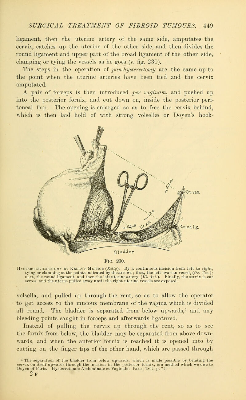 ligament, then the uterine artery of the same side, amputates the cervix, catches up the uterine of the other side, and then divides the round ligament and upper part of the broad ligament of the other side, clamping or tying the vessels as he goes (v. fig. 230). The steps in the operation of pan-hysterectomy are the same up to the point when the uterine arteries have been tied and the cervix amputated. A pair of forceps is then introduced per vaginam, and pushed up into the posterior fornix, and cut down on, inside the posterior peri- toneal flap. The opening is enlarged so as to free the cervix behind, which is then laid hold of with strong volsellae or Doyen's hook- Ov.ves. ound lig\ Fig. 230. Hystero-myomectomy by Kelly's Method (Kelly). By a continuous incision from left to right, tying or clamping at the points indicated by the arrows ; first, the left ovarian vessel, (Ov. Ves.); next, the round ligament, and then the left uterine artery, (Ut. Art.). Finally, the cervix is cut across, and the uterus pulled away until the right uterine vessels are exposed. volsella, and pulled up through the rent, so as to allow the operator to get access to the mucous membrane of the vagina which is divided all round. The bladder is separated from below upwards,1 and any bleeding points caught in forceps and afterwards ligatured. Instead of pulling the cervix up through the rent, so as to see the fornix from below, the bladder may be separated from above down- wards, and when the anterior fornix is reached it is opened into by cutting on the finger tips of the other hand, which are passed through 1 The separation of the bladder from below upwards, which is made possible by bending the cervix on itself upwards through the incision in the posterior fornix, is a method which we owe to Doyen of Paris. Hysterectomie Abdominale et Vaginale : Paris, 1892, p. 72. 2p