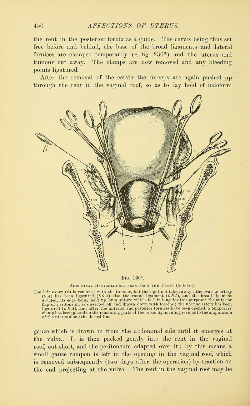 the rent in the posterior fornix as a guide. The cervix being thus set free before and behind, the base of the broad ligaments and lateral fornices are clamped temporarily (v. fig. 230*) and the uterus and tumour cut away. The clamps are now removed and any bleeding points ligatured. After the removal of the cervix the forceps are again pushed up through the rent in the vaginal roof, so as to lay hold of iodoform Fig. 230*. Abdominal Hysterectomy seen from the Front (Galabin). The left ovary (0) is removed with the tumour, but the right not taken away ; the ovarian artery (0 A) has been ligatured (LOA) also the round ligament (L R L), and the broad ligament divided, its edge being held up by a suture which is left long for this purpose ; the anterior flap of peritoneum is dissected off and drawn down with forceps ; the uterine artery has been ligatured (X UA), and after the anterior and posterior fornices have been opened, a temporary clamp has been placed on the remaining parts of the broad ligaments, previous to the amputation of the uterus along the dotted line. gauze which is drawn in from the abdominal side until it emerges at the vulva. It is then packed gently into the rent in the vaginal roof, cut short, and the peritoneum adapted over it; by this means a small gauze tampon is left in the opening in the vaginal roof, which is removed subsequently (two days after the operation) by traction on the end projecting at the vulva. The rent in the vaginal roof may be