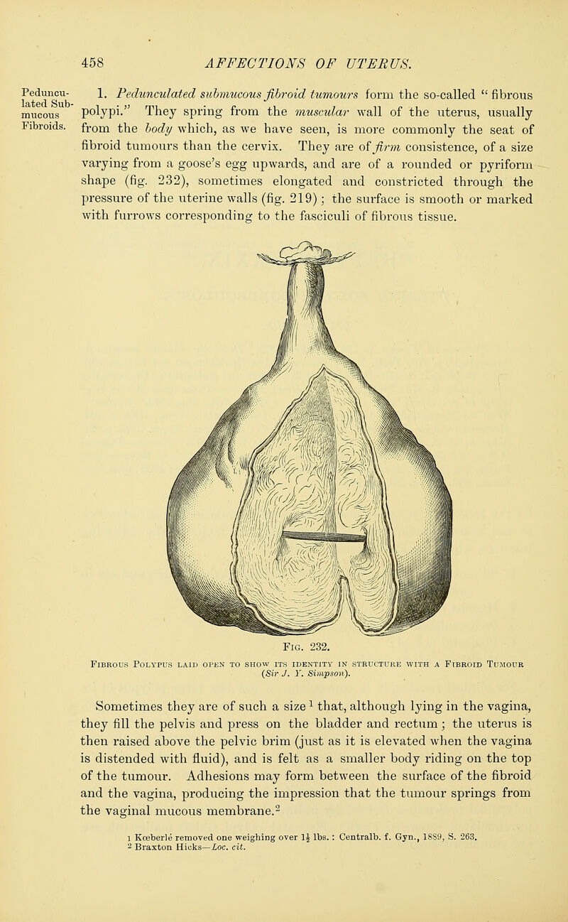 Peduncu- lated Sub- mucous Fibroids. 1. Pedunculated submucous fibroid tumours form the so-called fibrous polypi. They spring from the muscular wall of the uterus, usually from the body which, as we have seen, is more commonly the seat of fibroid tumours than the cervix. They are of firm consistence, of a size varying from a goose's egg upwards, and are of a rounded or pyriform shape (fig. 232), sometimes elongated and constricted through the pressure of the uterine walls (fig. 219); the surface is smooth or marked with furrows corresponding to the fasciculi of fibrous tissue. Fig. 232. Fibrous Polypus laid open to show its identity in structure with a Fibroid Tumour (Sir J. Y. Simpson). Sometimes they are of such a size1 that, although lying in the vagina, they fill the pelvis and press on the bladder and rectum; the uterus is then raised above the pelvic brim (just as it is elevated when the vagina is distended with fluid), and is felt as a smaller body riding on the top of the tumour. Adhesions may form between the surface of the fibroid and the vagina, producing the impression that the tumour springs from the vaginal mucous membrane.2 i Koeberle removed one weighing over 1J lbs. : Centralb. f. Gyn., 18S9, S. 263. 2 Braxton Hicks—Loc. cit.
