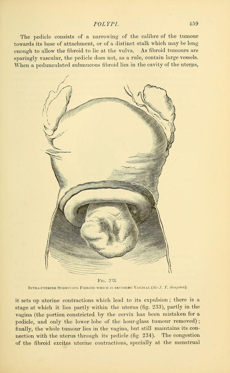 The pedicle consists of a narrowing of the calibre of the tumour towards its base of attachment, or of a distinct stalk which may be long enough to allow the fibroid to lie at the vulva. As fibroid tumours are sparingly vascular, the pedicle does not, as a rule, contain large vessels. When a pedunculated submucous fibroid lies in the cavity of the uterus, Fig. 2*3. Intra-uterine Submucous Fibroid which is becoming Vaginal (Sir J. Y. Simpson). it sets up uterine contractions which lead to its expulsion ; there is a stage at which it lies partly within the uterus (fig. 233), partly in the vagina (the portion constricted by the cervix has been mistaken for a pedicle, and only the lower lobe of the hour-glass tumour removed); finally, the whole tumour lies in the vagina, but still maintains its con- nection with the uterus through its pedicle (fig. 234). The congestion of the fibroid excites uterine contractions, specially at the menstrual