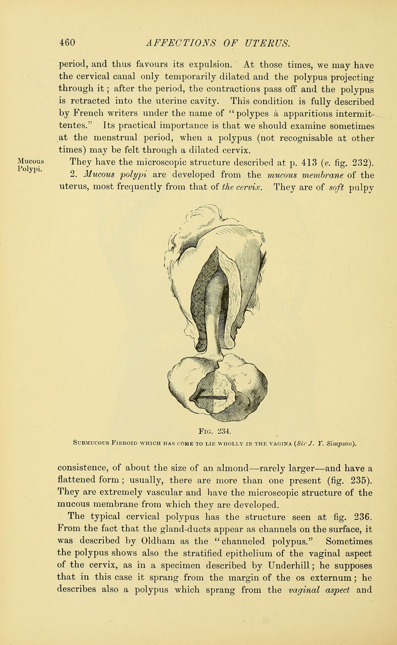 Mucous Polypi. period, and thus favours its expulsion. At those times, we may have the cervical canal only temporarily dilated and the polypus projecting through it; after the period, the contractions pass off and the polypus is retracted into the uterine cavity. This condition is fully described by French writers under the name of polypes a apparitions intermit- tentes. Its practical importance is that we should examine sometimes at the menstrual period, when a polypus (not recognisable at other times) may be felt through a dilated cervix. They have the microscopic structure described at p. 413 (v. fig. 232). 2. Mucous polypi are developed from the mucous membrane of the uterus, most frequently from that of the cervix. They are of soft pulpy Fig. 234. Submucous Fibroid which has come to lie wholly in the vagina (Sir J. Y. Simpson). consistence, of about the size of an almond—rarely larger—and have a flattened form; usually, there are more than one present (fig. 235). They are extremely vascular and have the microscopic structure of the mucous membrane from which they are developed. The typical cervical polypus has the structure seen at fig. 236. From the fact that the gland-ducts appear as channels on the surface, it was described by Oldham as the channeled polypus. Sometimes the polypus shows also the stratified epithelium of the vaginal aspect of the cervix, as in a specimen described by Underhill; he supposes that in this case it sprang from the margin of the os externum; he describes also a polypus which sprang from the vaginal aspect and