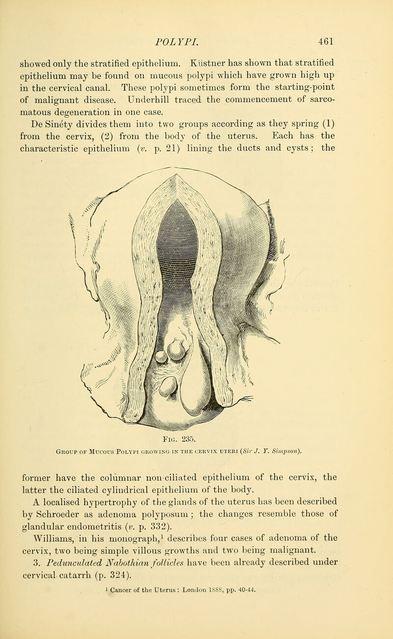 showed only the stratified epithelium. Kiistner has shown that stratified epithelium may be found on mucous polypi which have grown high up in the cervical canal. These polypi sometimes form the starting-point of malignant disease. Underhill traced the commencement of sarco- matous degeneration in one case. De Sinety divides them into two groups according as they spring (1) from the cervix, (2) from the body of the uterus. Each has the characteristic epithelium (v. p. 21) lining the ducts and cysts; the Fig. 235. Group of Mucous Polypi growing in the cervix uteri (Sir J. T. Simpson). former have the columnar non-ciliated epithelium of the cervix, the latter the ciliated cylindrical epithelium of the body. A localised hypertrophy of the glands of the uterus has been described by Schroeder as adenoma polyposum; the changes resemhle those of glandular endometritis (v. p. 332). Williams, in his monograph,1 describes four cases of adenoma of the cervix, two being simple villous growths and two being malignant. 3. Pedunculated Nabothian follicles have been already described under cervical-catarrh (p. 324). -1 Cancer of the Uterus : London 1SSS, pp. 40-44.