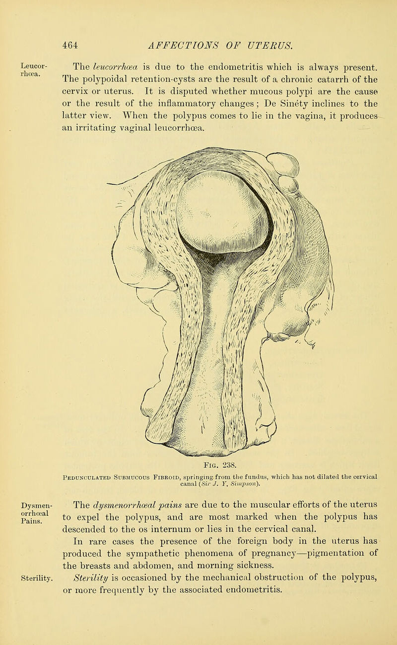 Leucor- rhoea. The leucorrhoea is due to the endometritis which is always present. The polypoidal i*etention-cysts are the result of a chronic catarrh of the cervix or uterus. It is disputed whether mucous polypi are the cause or the result of the inflammatory changes ; De Sinety inclines to the latter view. When the polypus comes to lie in the vagina, it produces an irritating vaginal leucorrhoea. Fig. 238. Pedunculated Submucous Fibroid, springing from the fundus, which has not dilated the cervical canal (Sir J. Y. Simpson). Dysmen- orrhoeal Pains. Sterility. The clysinenorrhoeal pains are due to the muscular efforts of the uterus to expel the polypus, and are most marked when the polypus has descended to the os internum or lies in the cervical canal. In rare cases the presence of the foreign body in the uterus has produced the sympathetic phenomena of pregnancy—pigmentation of the breasts and abdomen, and morning sickness. Sterility is occasioned by the mechanical obstruction of the polypus, or more frequently by the associated endometritis.